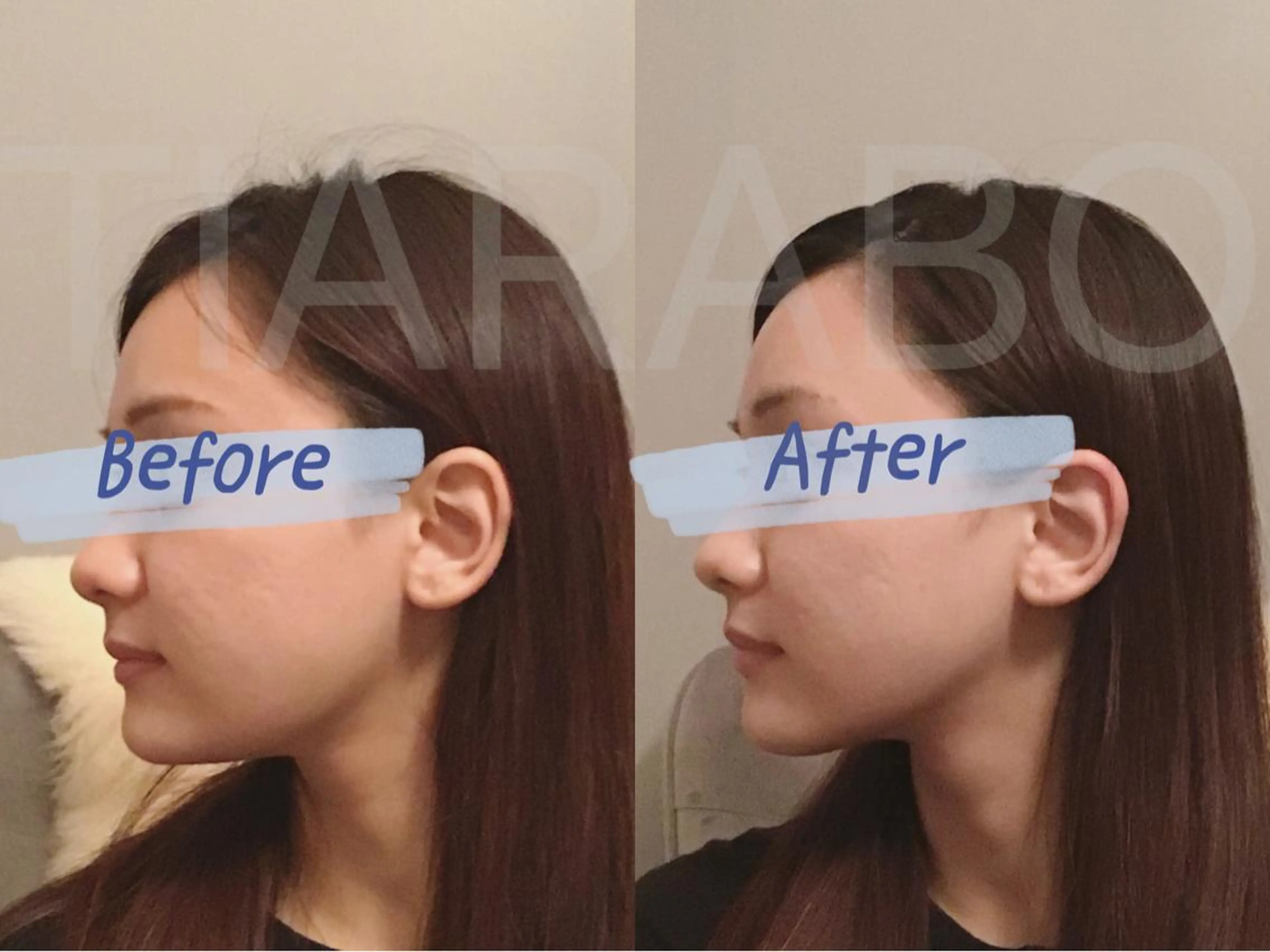 【贅沢小顔美容鍼110分】全身×小顔電気鍼+デコルテ​〜​小顔リフトフェイシャル+ツヤUP保湿パック+ドライヘッドスパ+首肩の写真