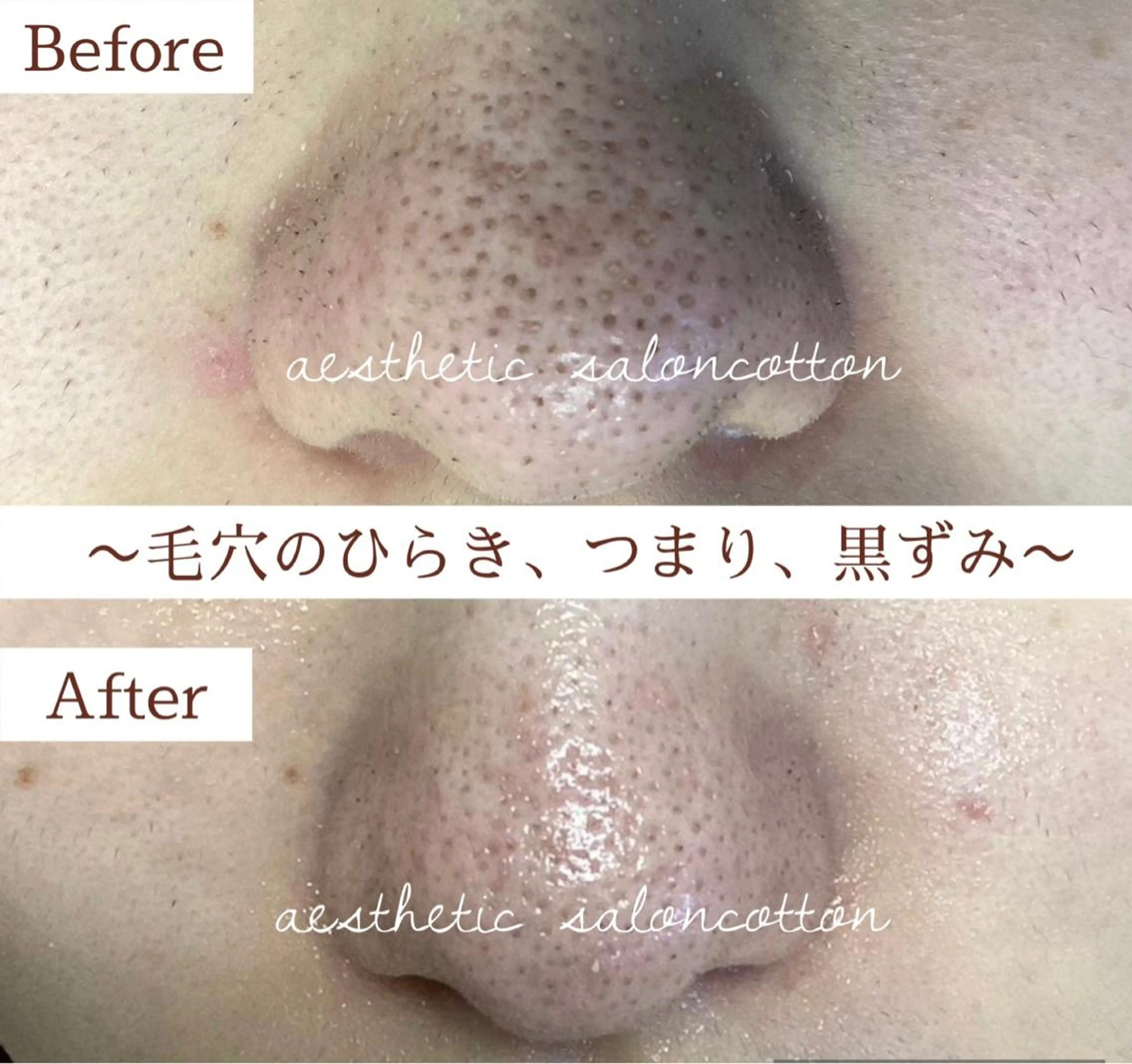 【人気No2】本気の毛穴ケア👃強力超音波毛穴洗浄+引き締めコース/毛穴の黒ずみ/ひらき/皮脂づまり徹底ケアの写真