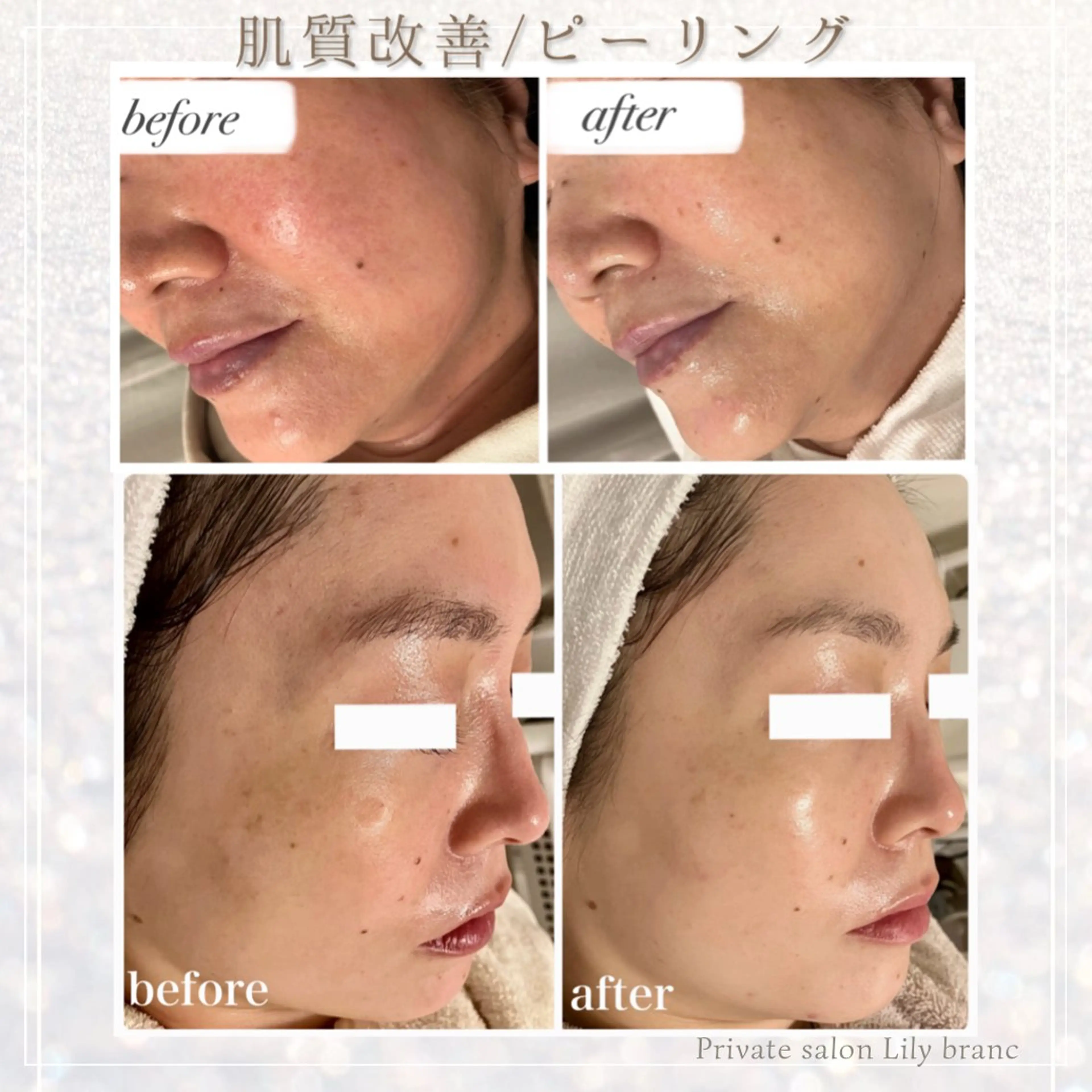 Lily branc 痩身/小顔/肌質改善のエステ・リラクイメージ