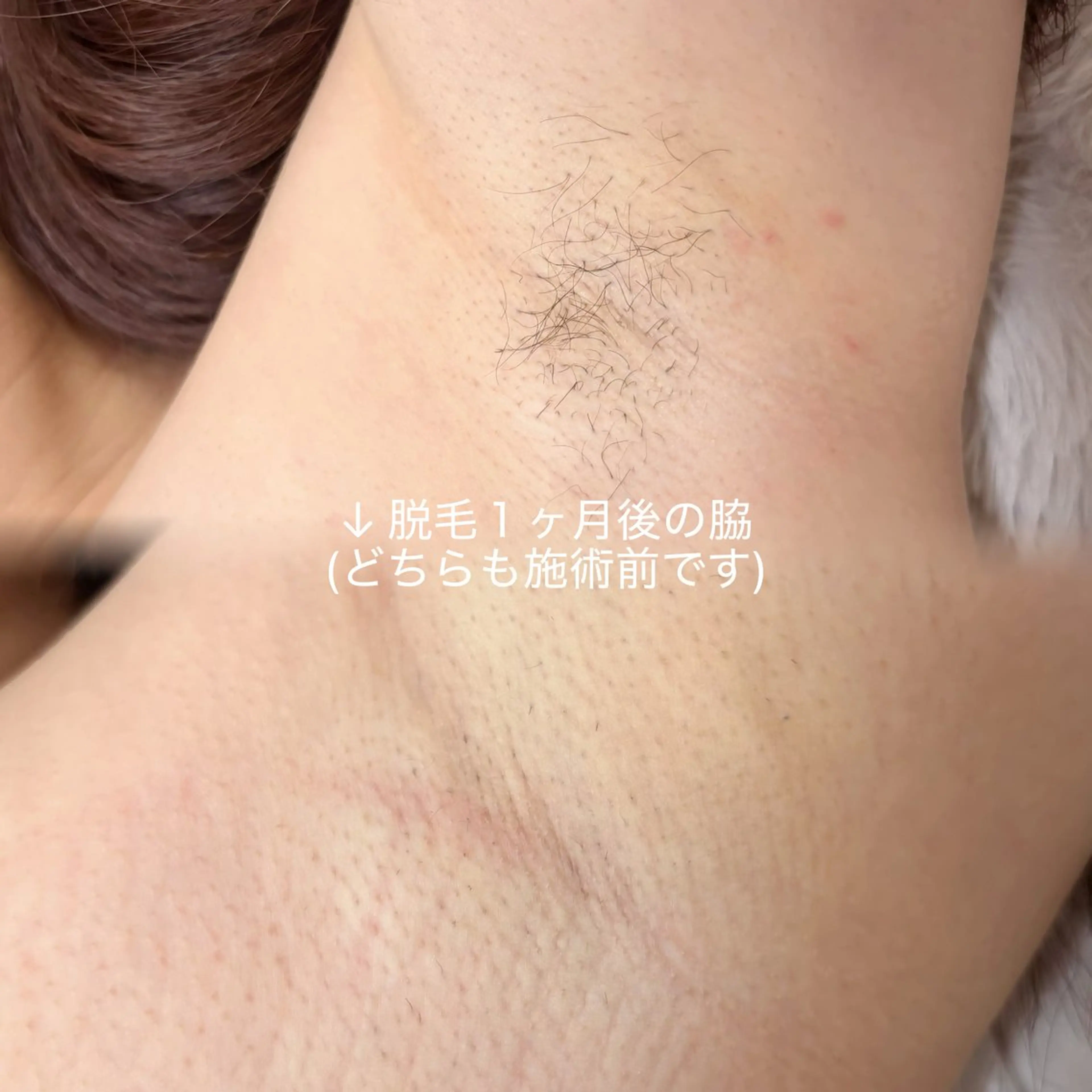 脱毛 PIMIL佐々木 亜里沙のエステ・リラクイメージ
