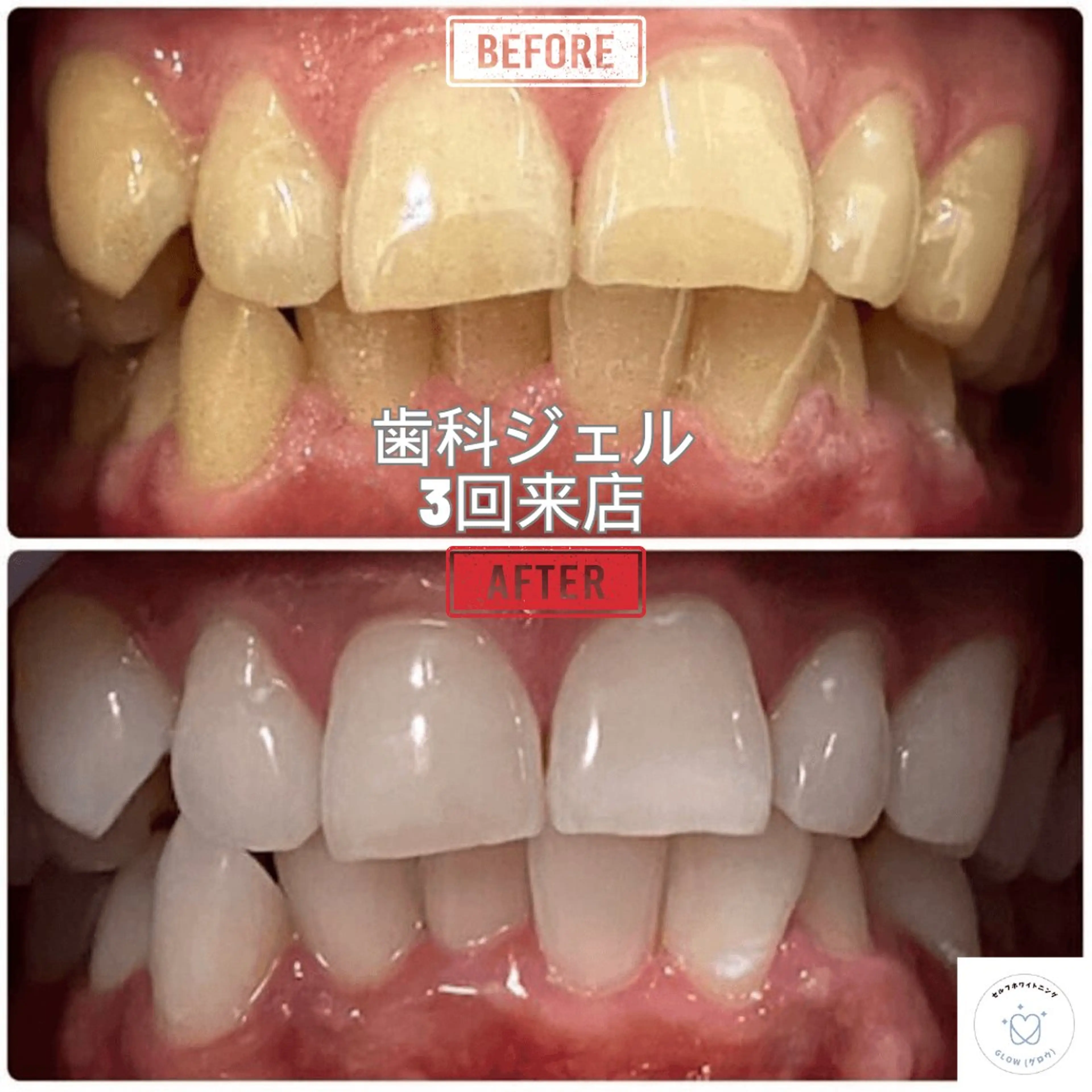 その他 東区香椎歯のセルフホ ワイトニングGLOWのその他イメージ