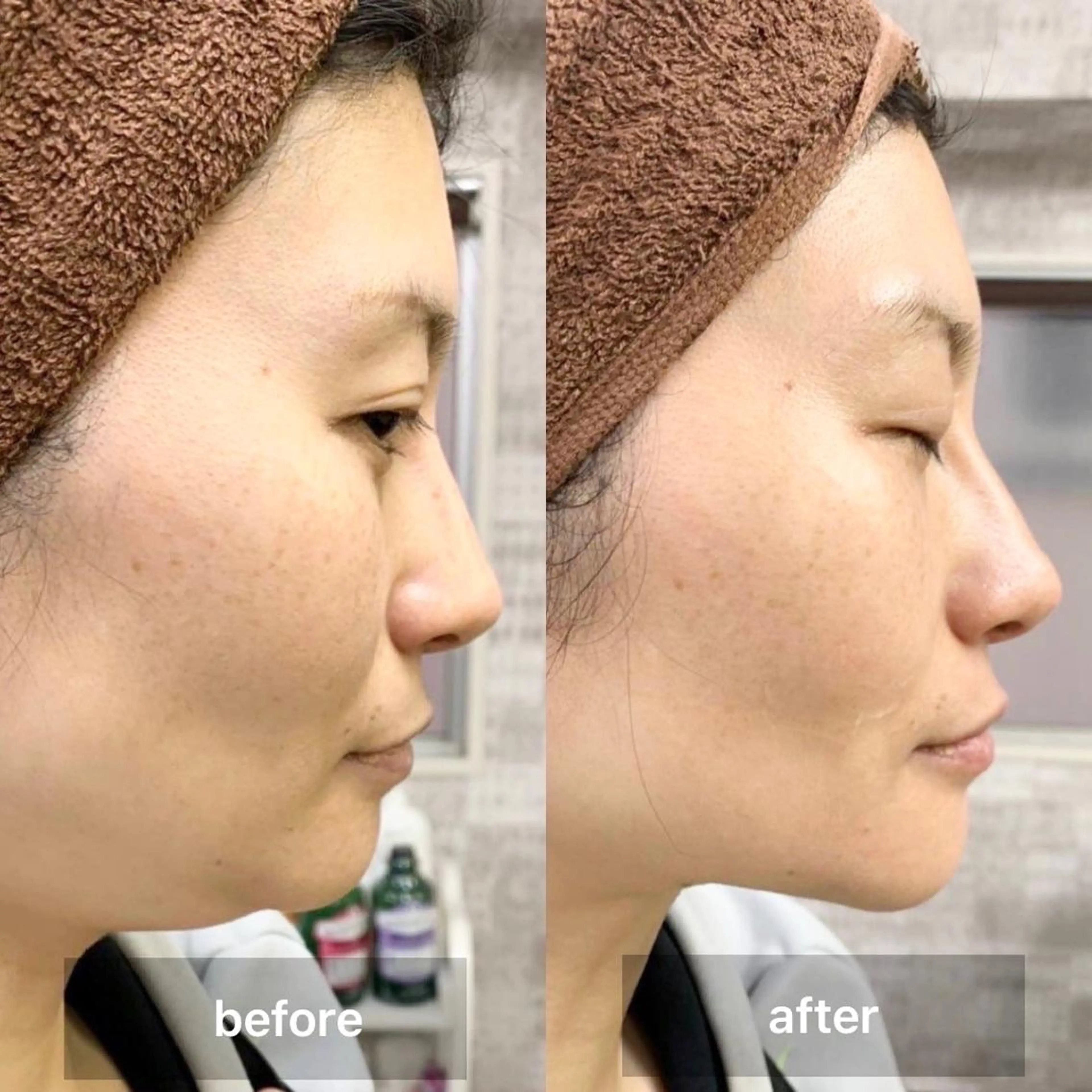 韓国風コルギ(小顔矯正)の写真