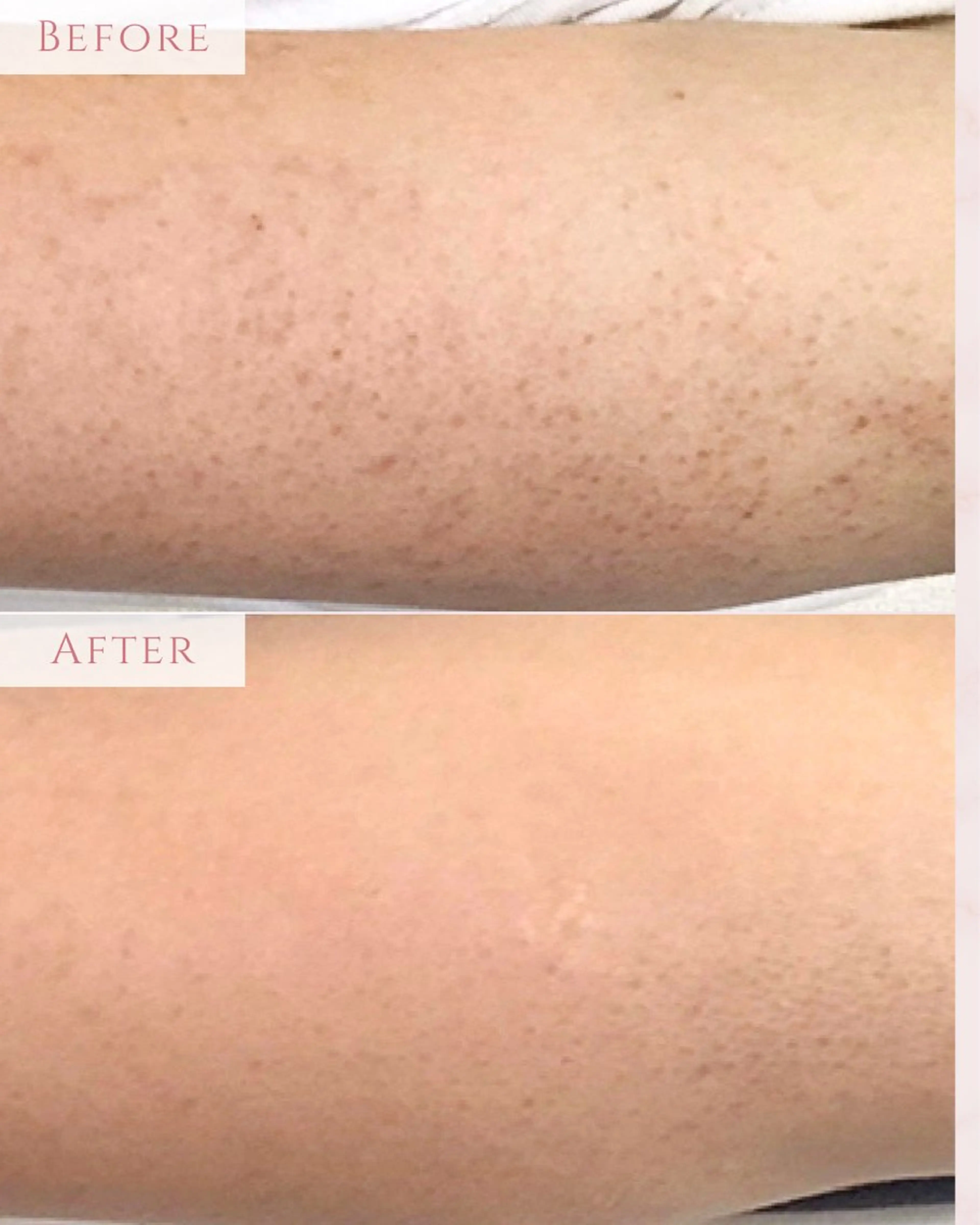 【ミニモ限定価格❤️‍🔥】二の腕集中ケア❗️ハーブピーリングで魅せ肌仕上げ🌿✨初回¥22,000→¥13,000の写真