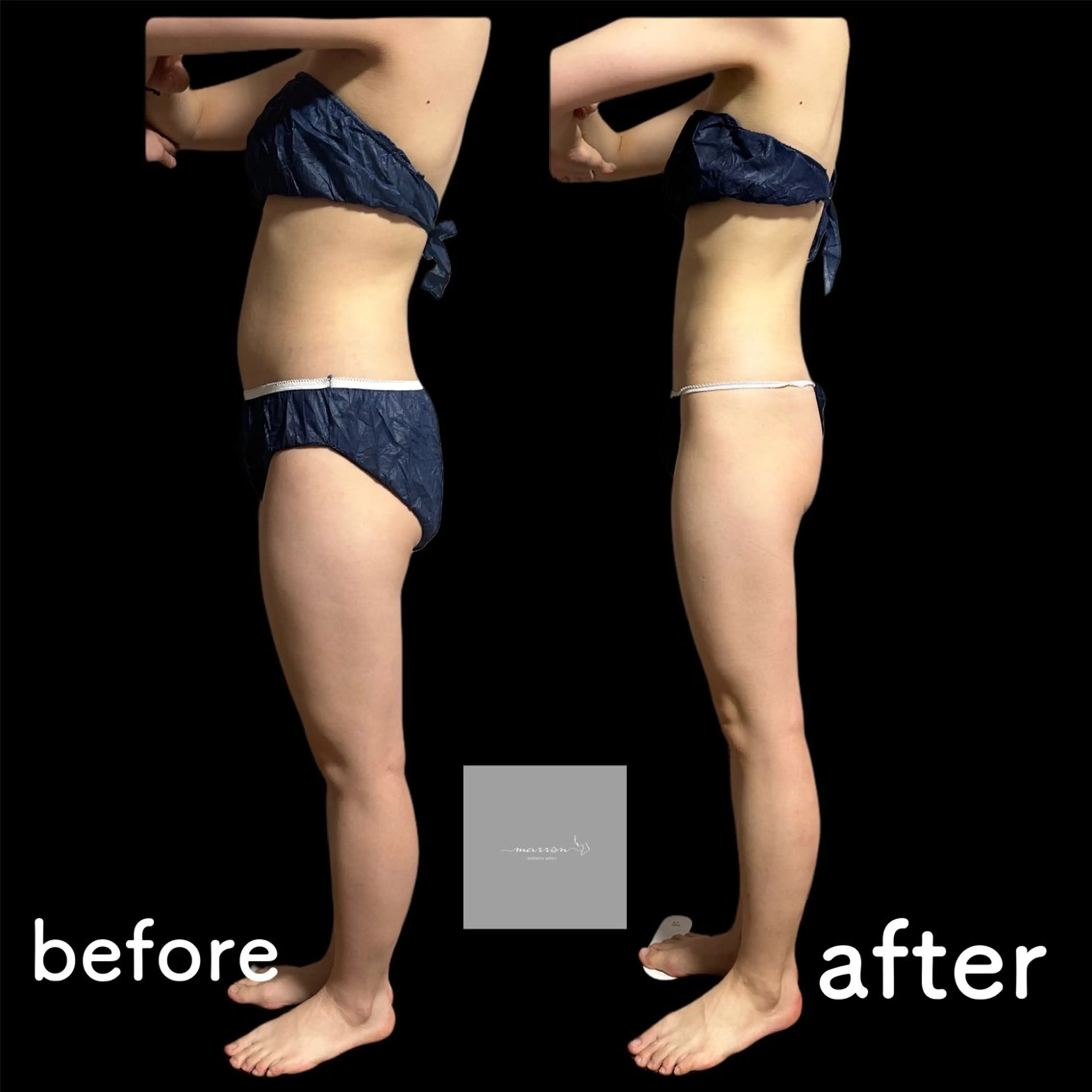 痩身ハイパーナイフ ララピールリアボーテのエステ・リラクイメージ