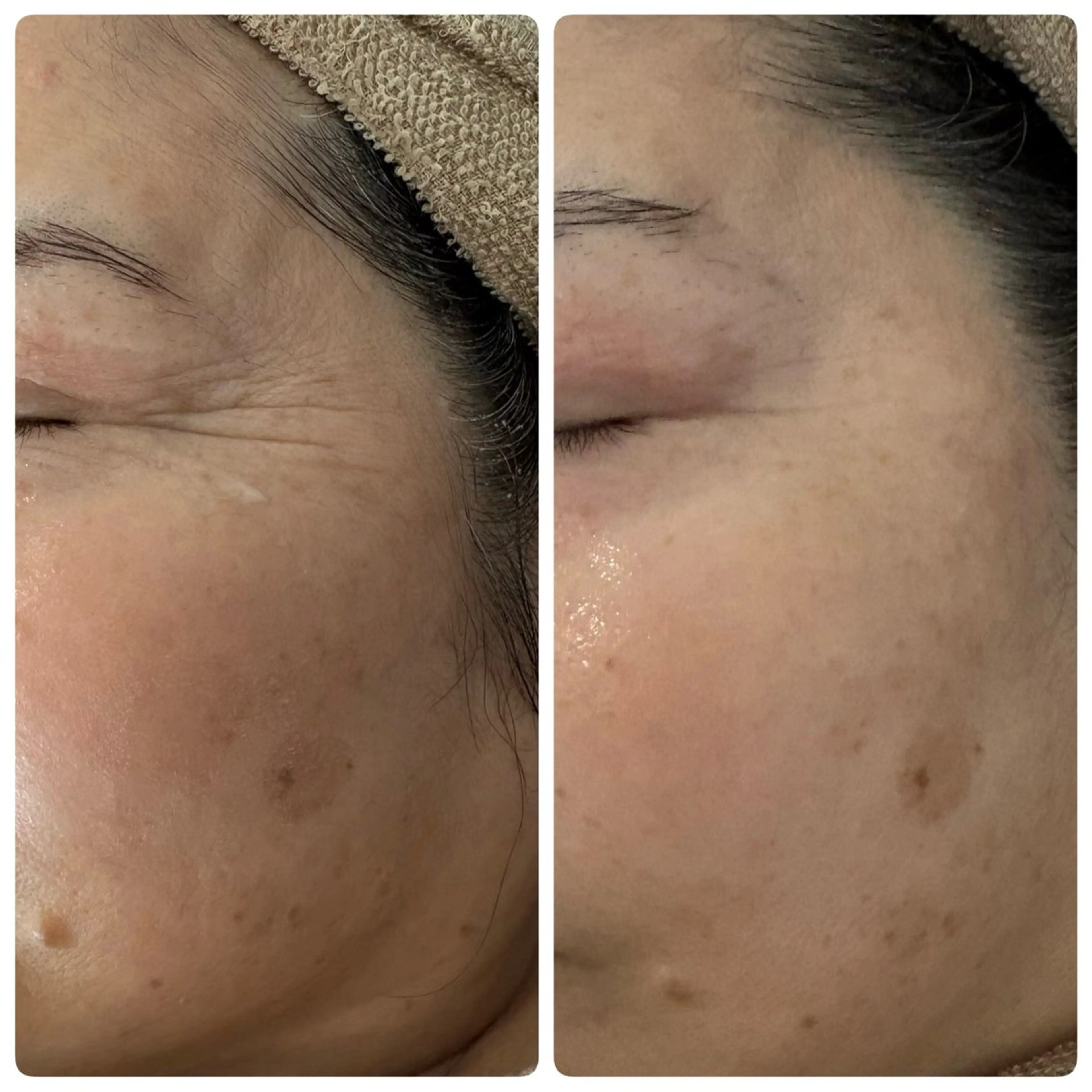 光フェイシャルの写真