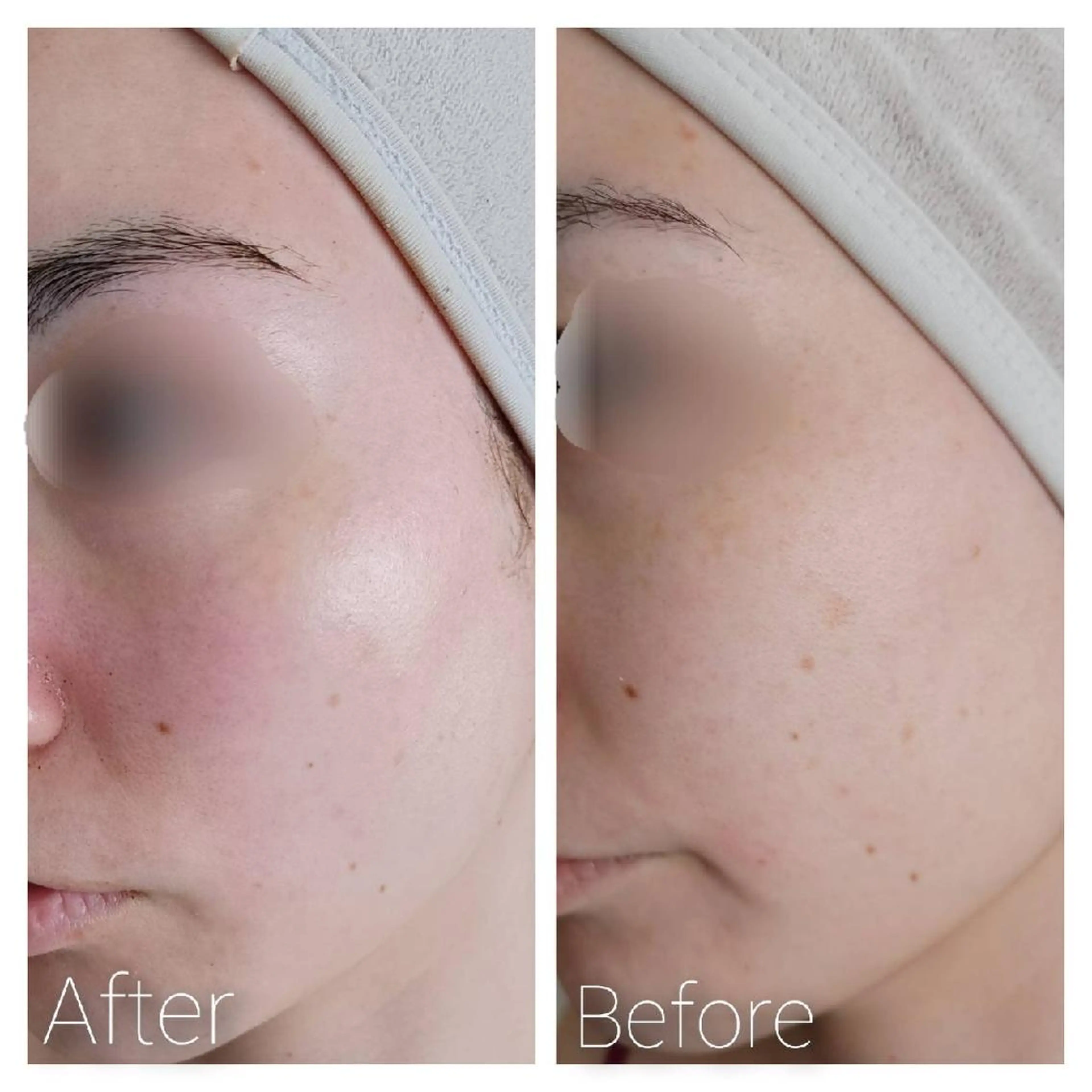 V.O.S肌再生トリートメント+ドライヘッドスパ付きの写真