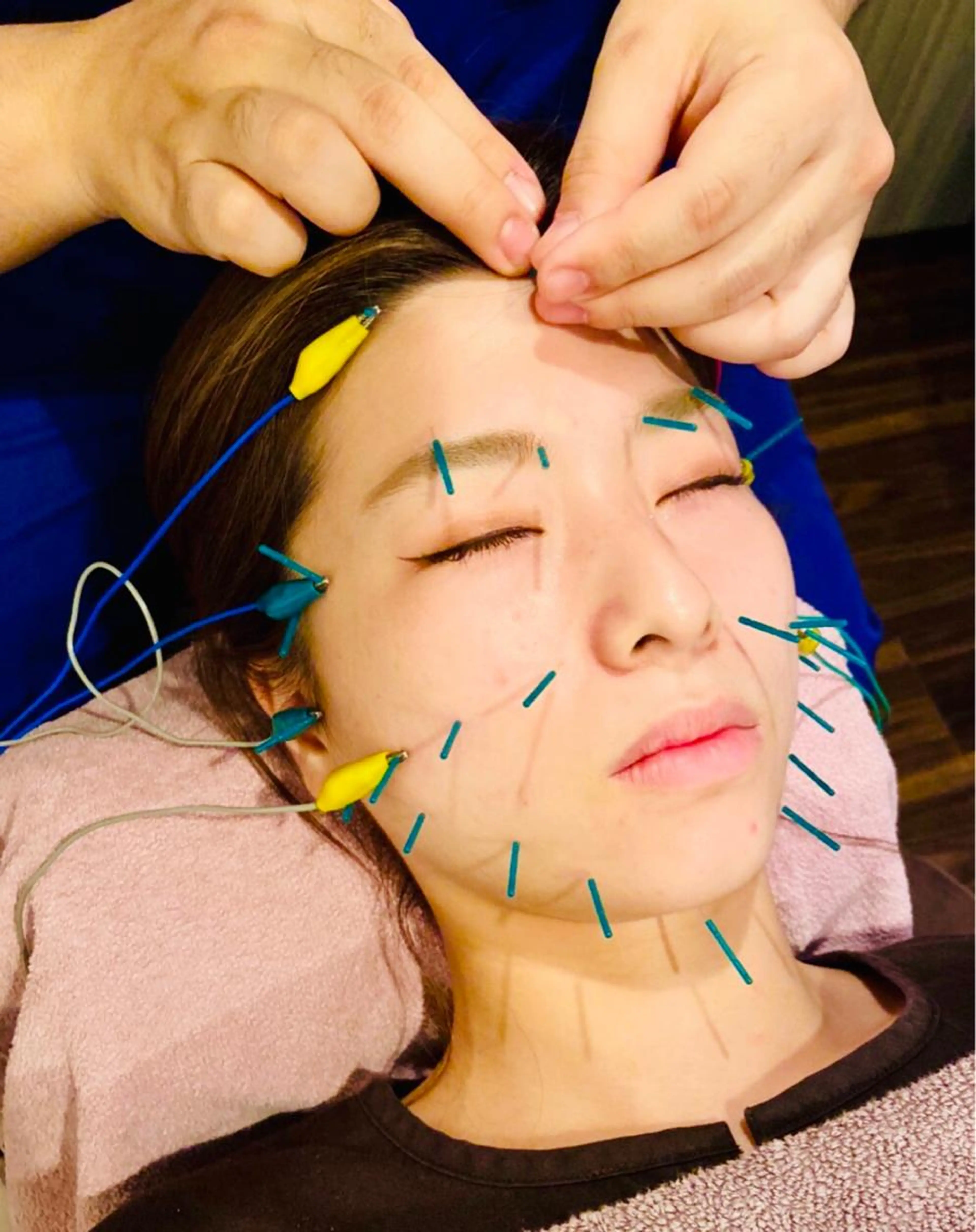 美容鍼・美顔鍼🌸30%OFF🤝30分4800円‼️目の疲れや頭痛の方もお試し感覚でどうぞ😌の写真