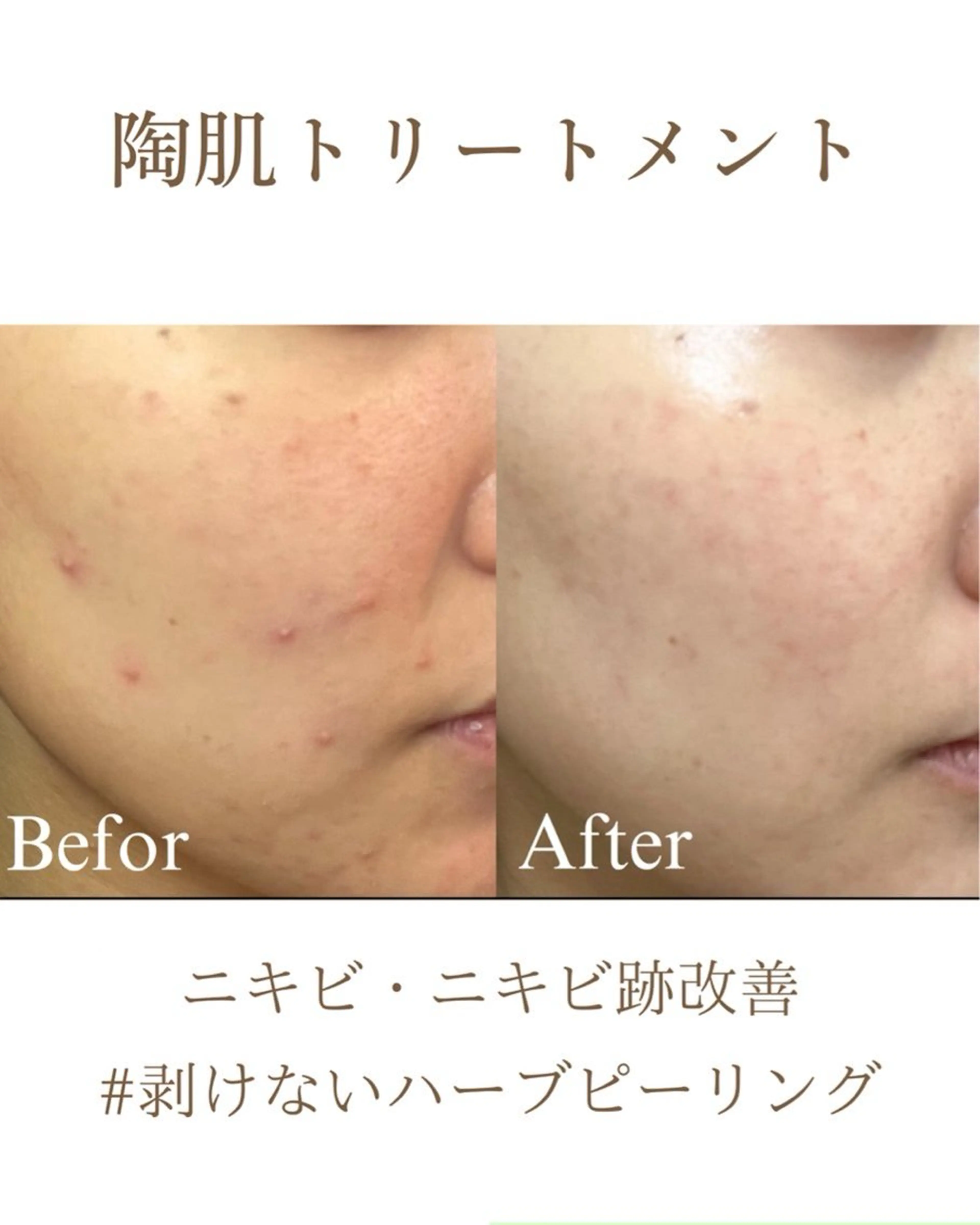 エステ ハーブピーリング専門 毛穴洗浄❤️眉waxのエステ・リラクイメージ