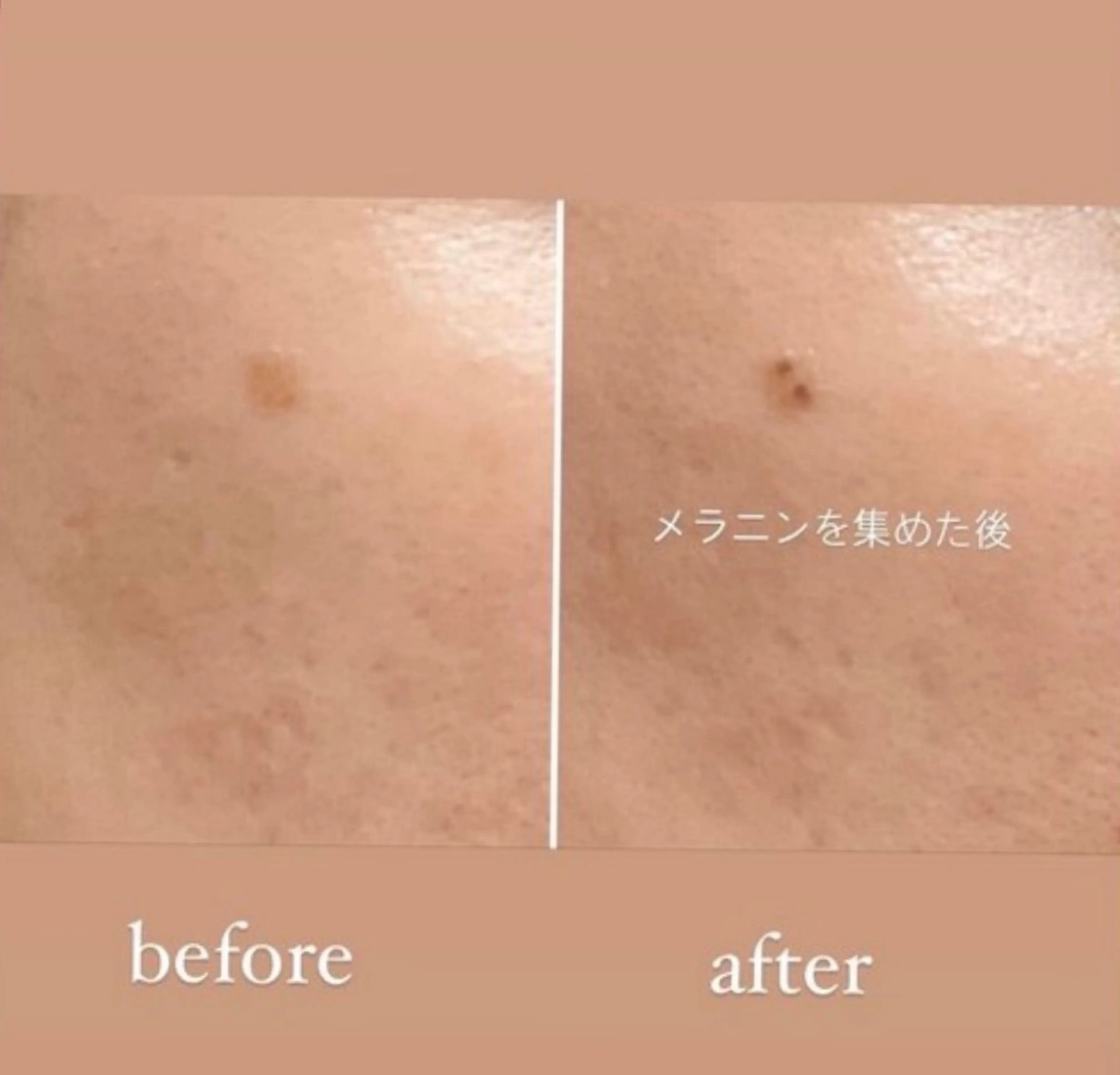 【スポットケア●○】Othelloスポットケア●○10分当て放題 ¥3,980の写真