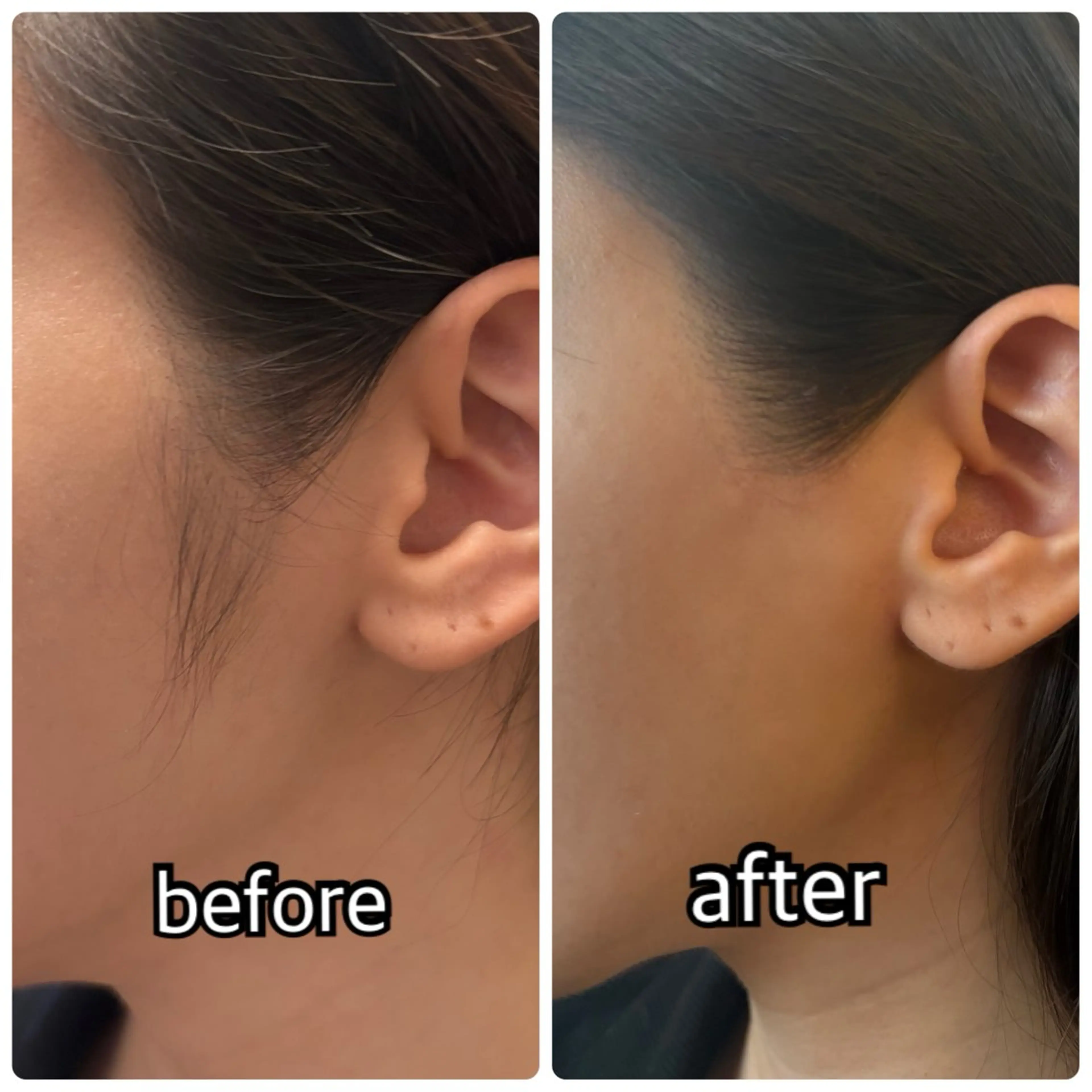 【先着10名】もみあげ&うなじWax脱毛モニター⚠️注意事項お読みくださいの写真