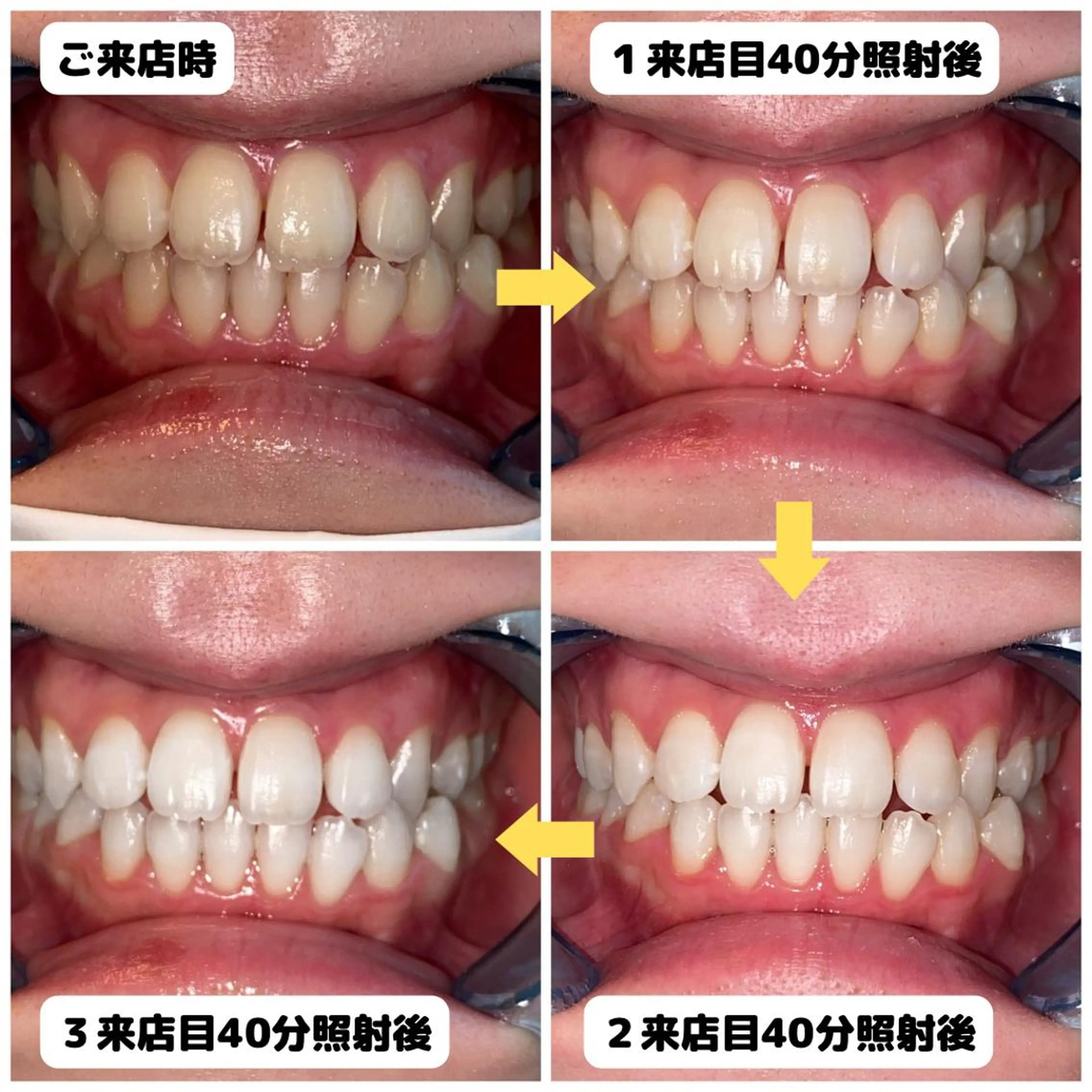 【 メンズ限定 】🔹 メンズ美歯集中プラン 〈 40分×3来店   合計120分照射  〉🔹の写真