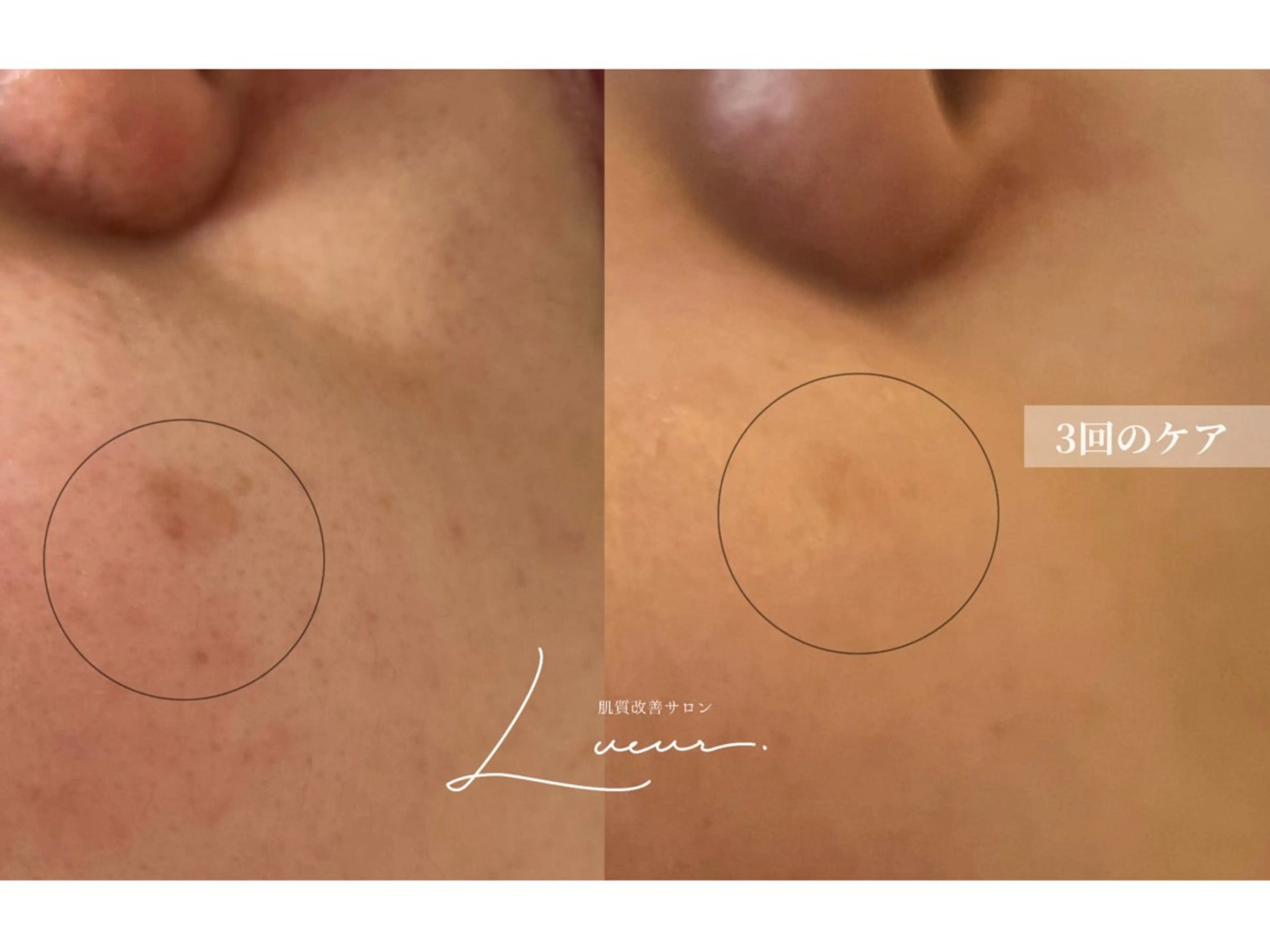 エステ 肌質改善サロン Lueurリュールのエステ・リラクイメージ