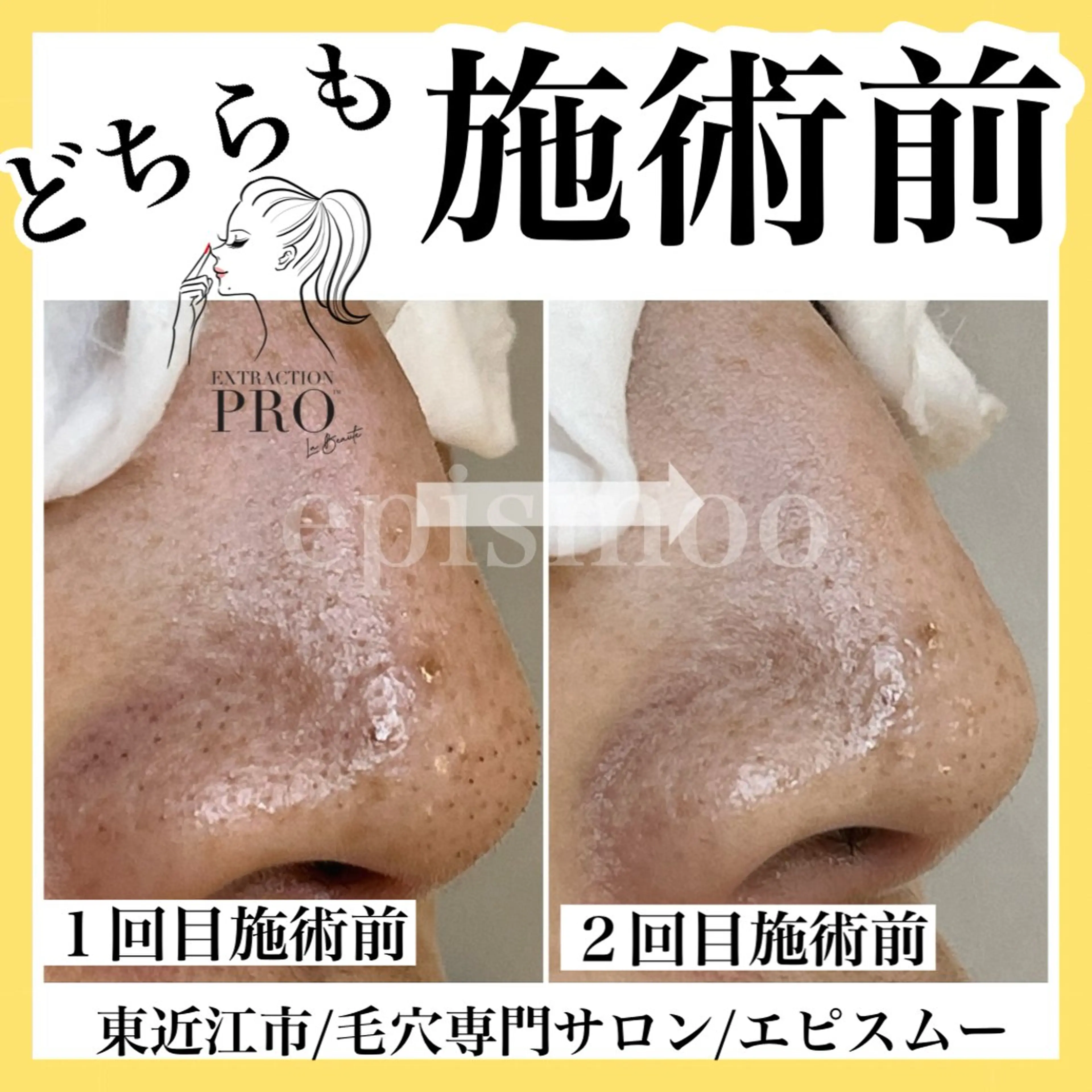 メンズ epismoo 脱毛/HBL/毛穴の眉毛・アイブロウイメージ