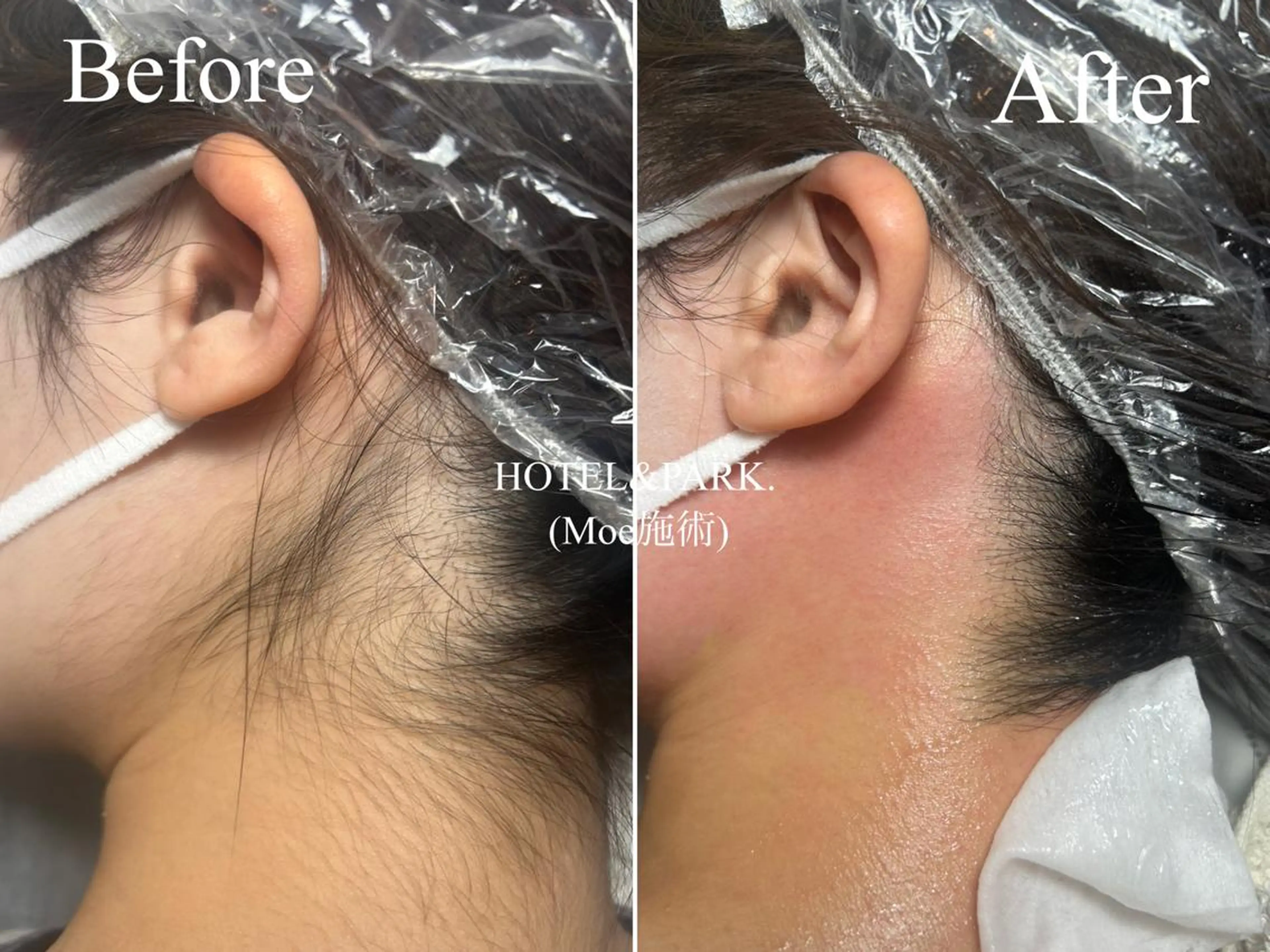 HOTEL&PARK . ワックス脱毛のエステ・リラクイメージ