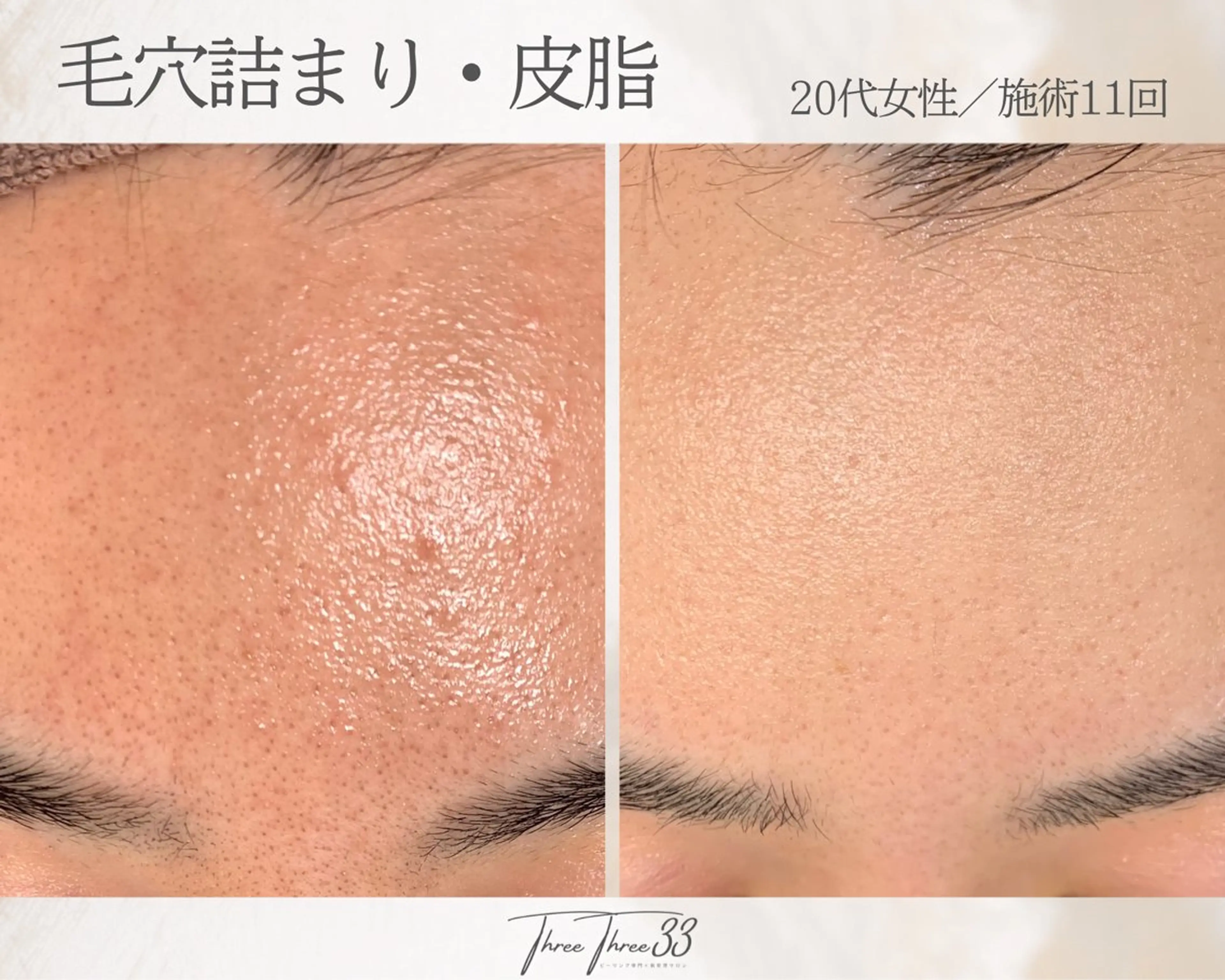 エステ ピーリング×肌管理 THREETHREEのエステ・リラクイメージ