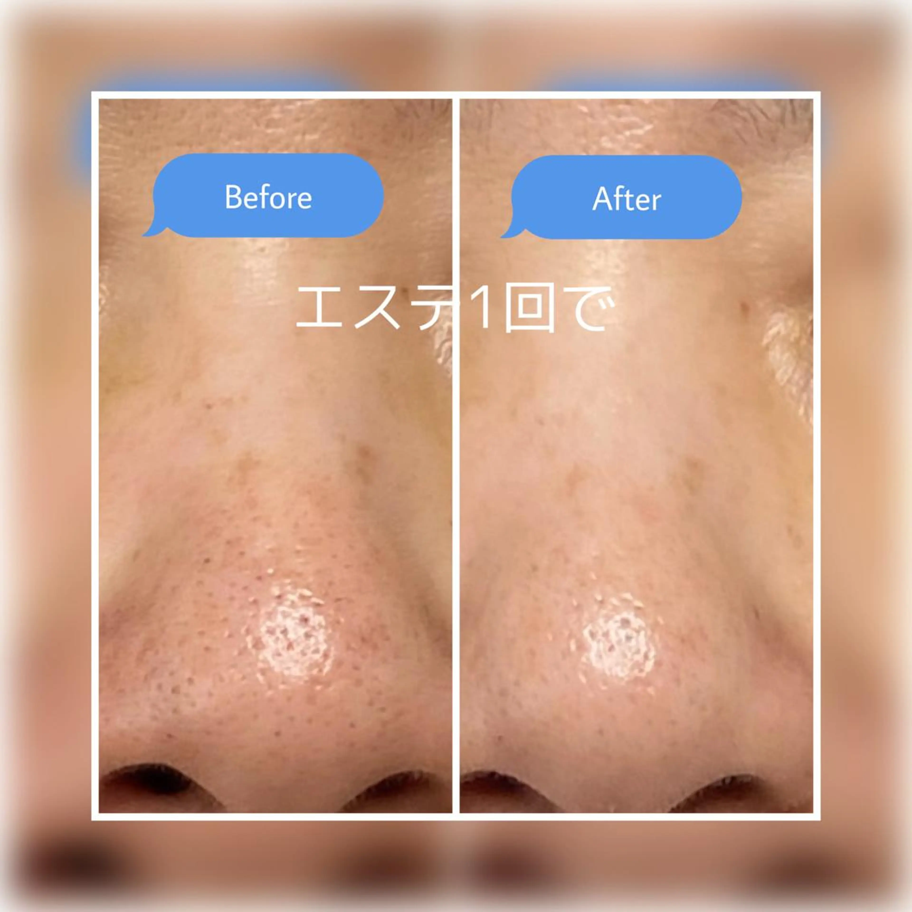 毛穴汚れスッキリコースの写真