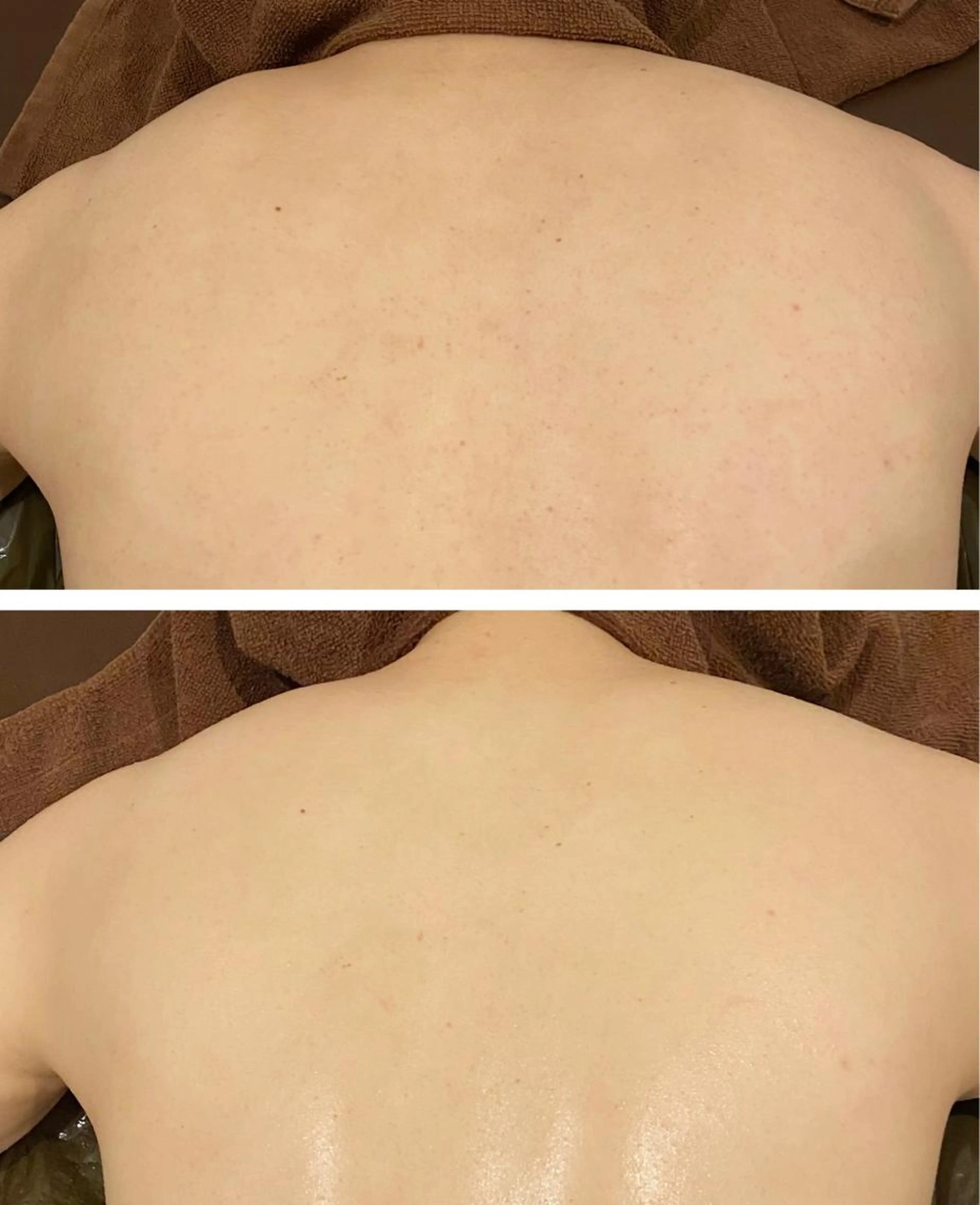 肌荒れの無い美背中に🪞酵素ハーブピーリングで徹底毛穴ケア🤍ツヤのあるきめ細かいお背中に💫の写真