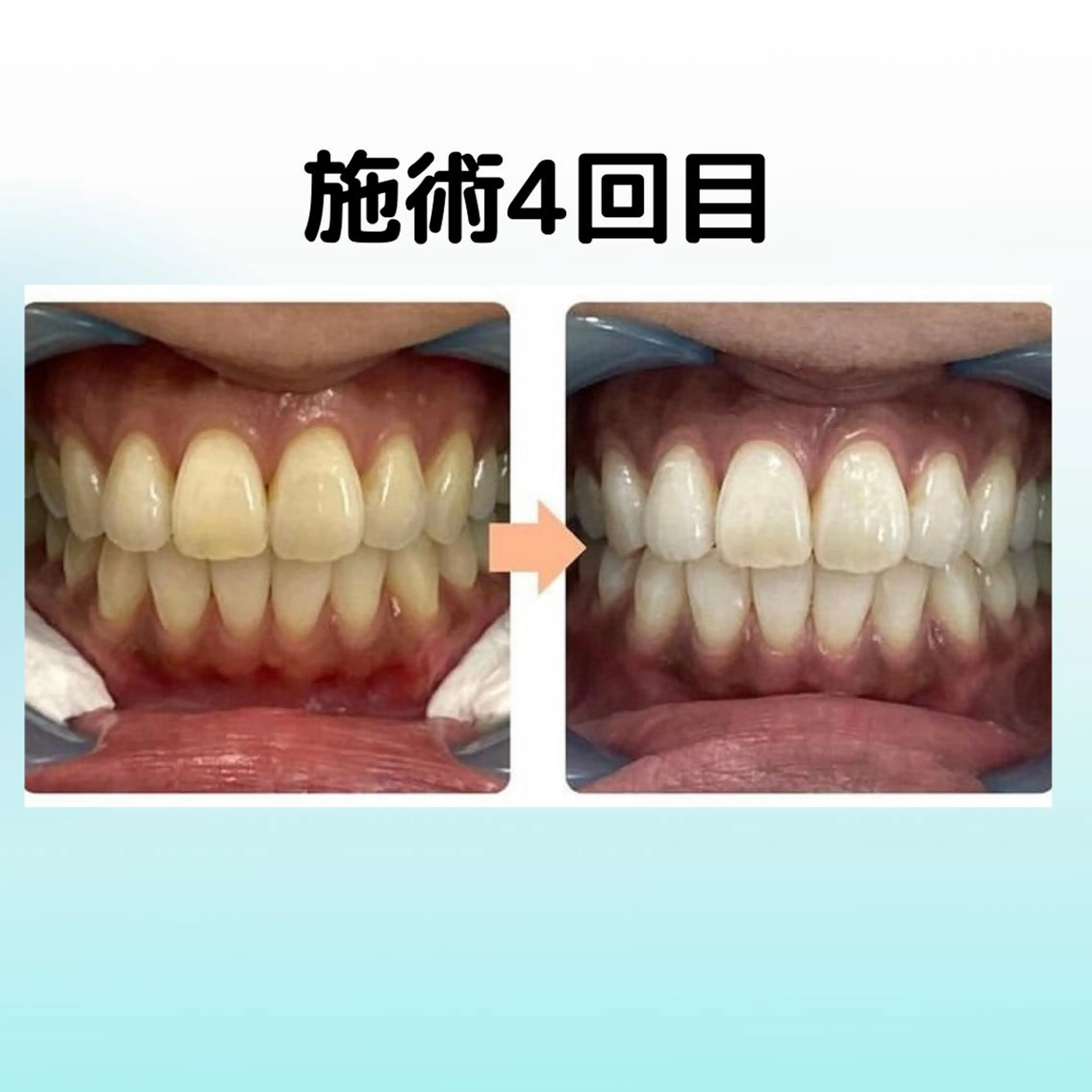 その他 ホワイトニング シャトンのその他イメージ