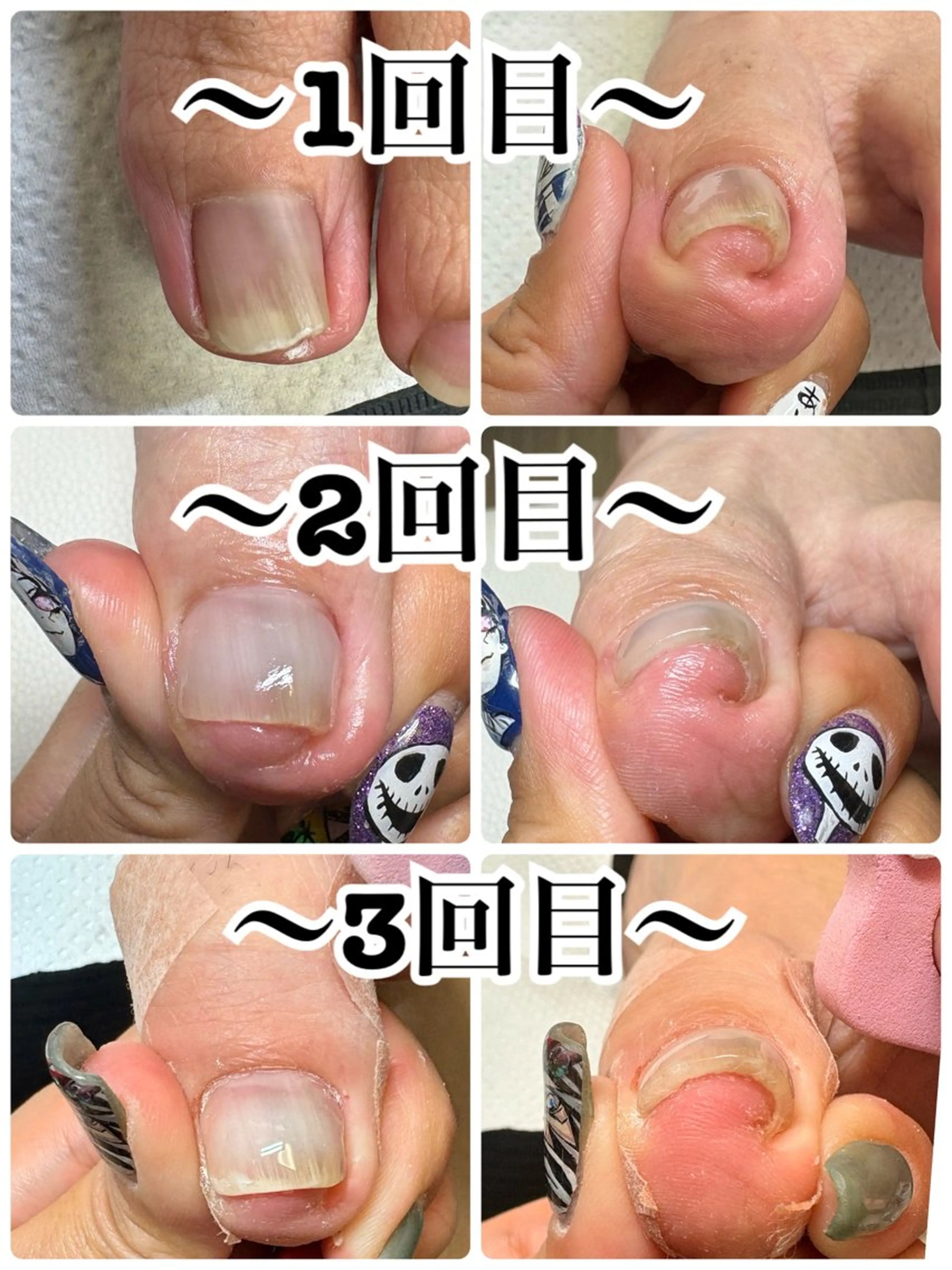 HeySwitch 巻き爪ケア＋プチフットマッサージ付きの写真