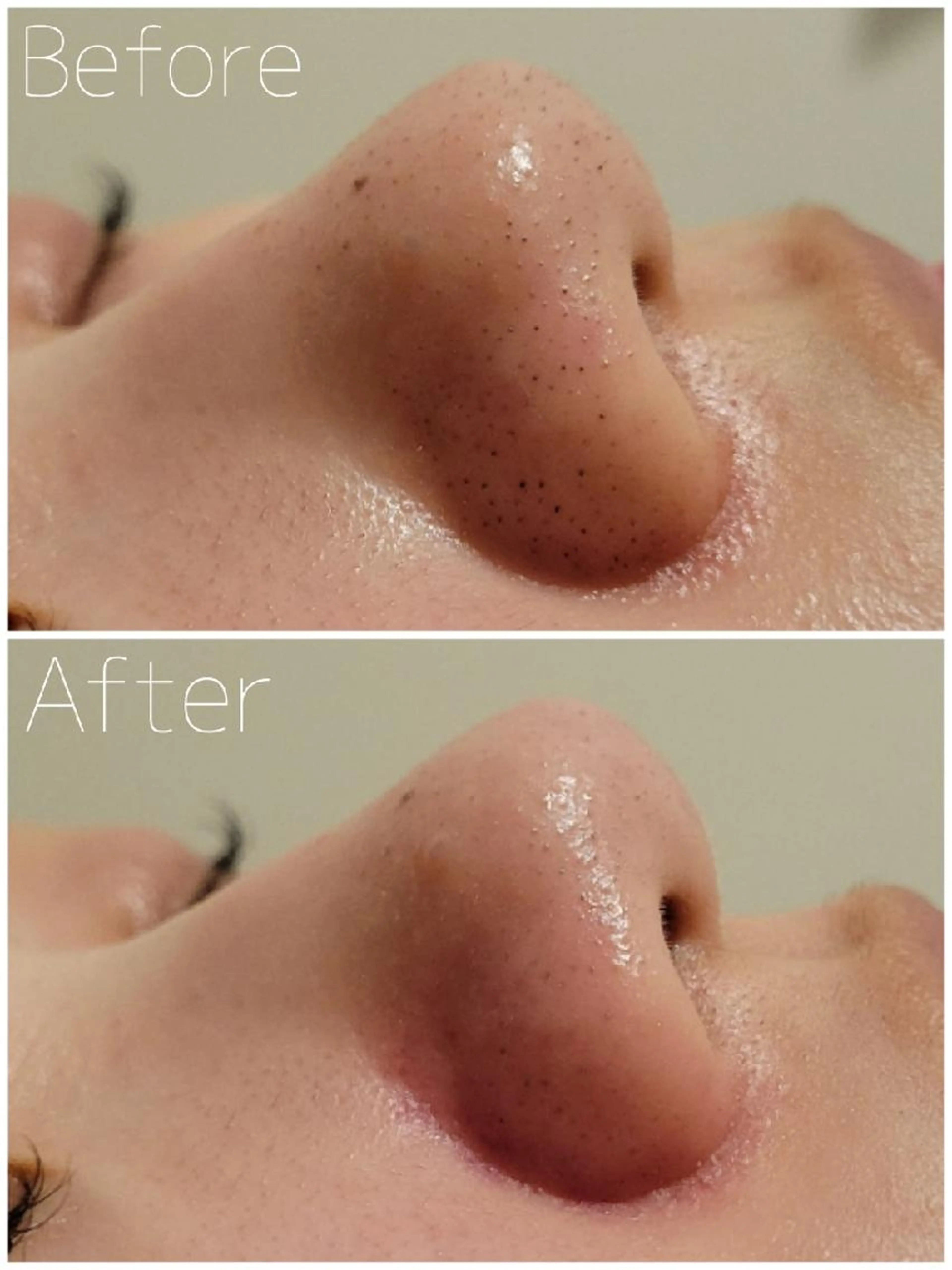 【毛穴の角栓・黒ずみケア‎】毛穴洗浄/ピーリング/肌管理 16500円➡の写真