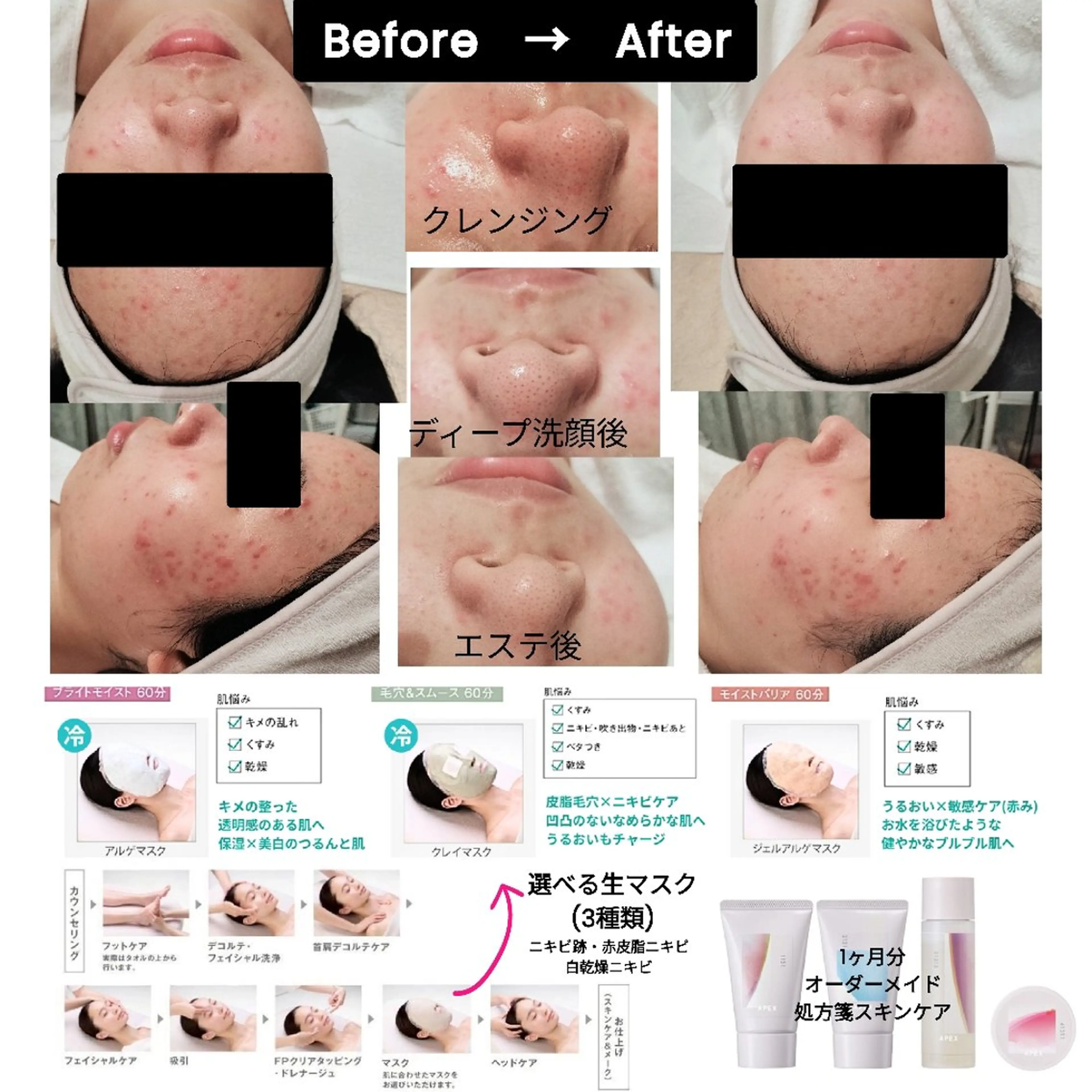 🫧皮脂毛穴ケア🫧全身エステ＋1ヶ月分オーダーメイドスキンケア付き📝の写真