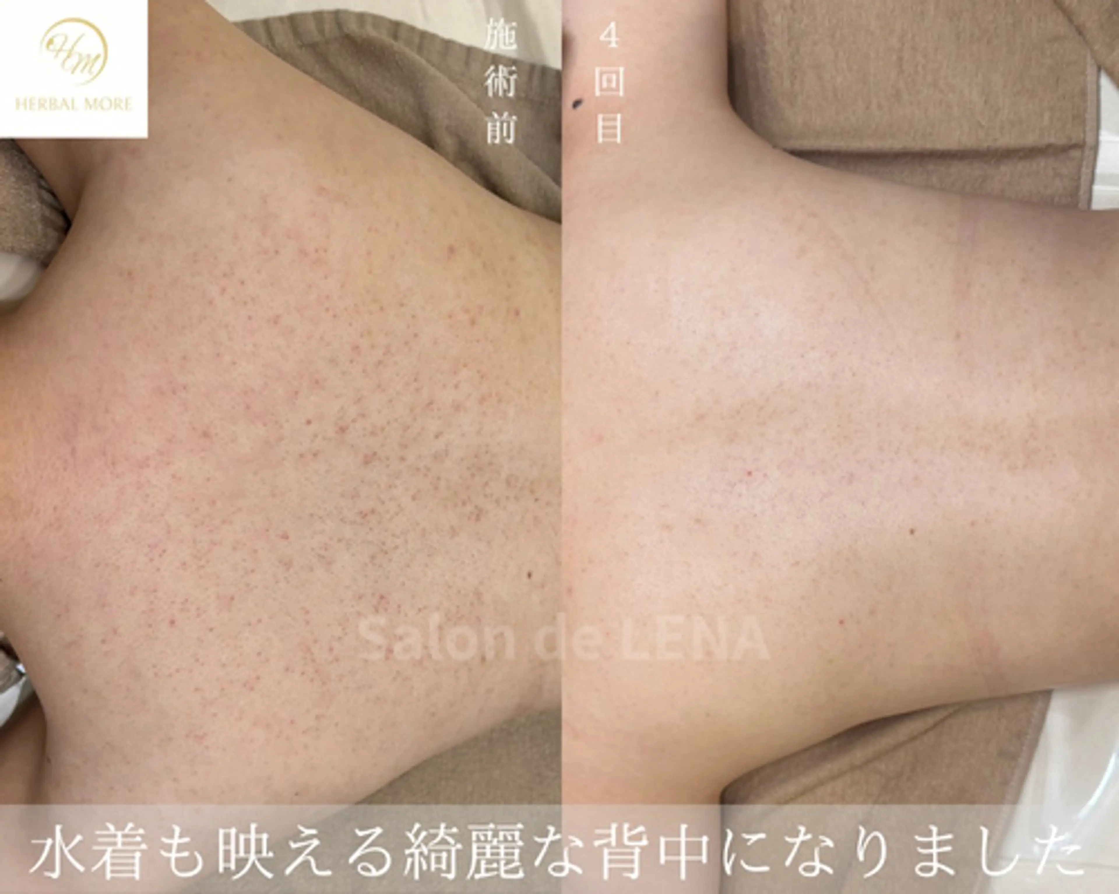 【Xmasイベント】剥けないハーブピーリング＜体用/全身好きな箇所から1つ）の写真