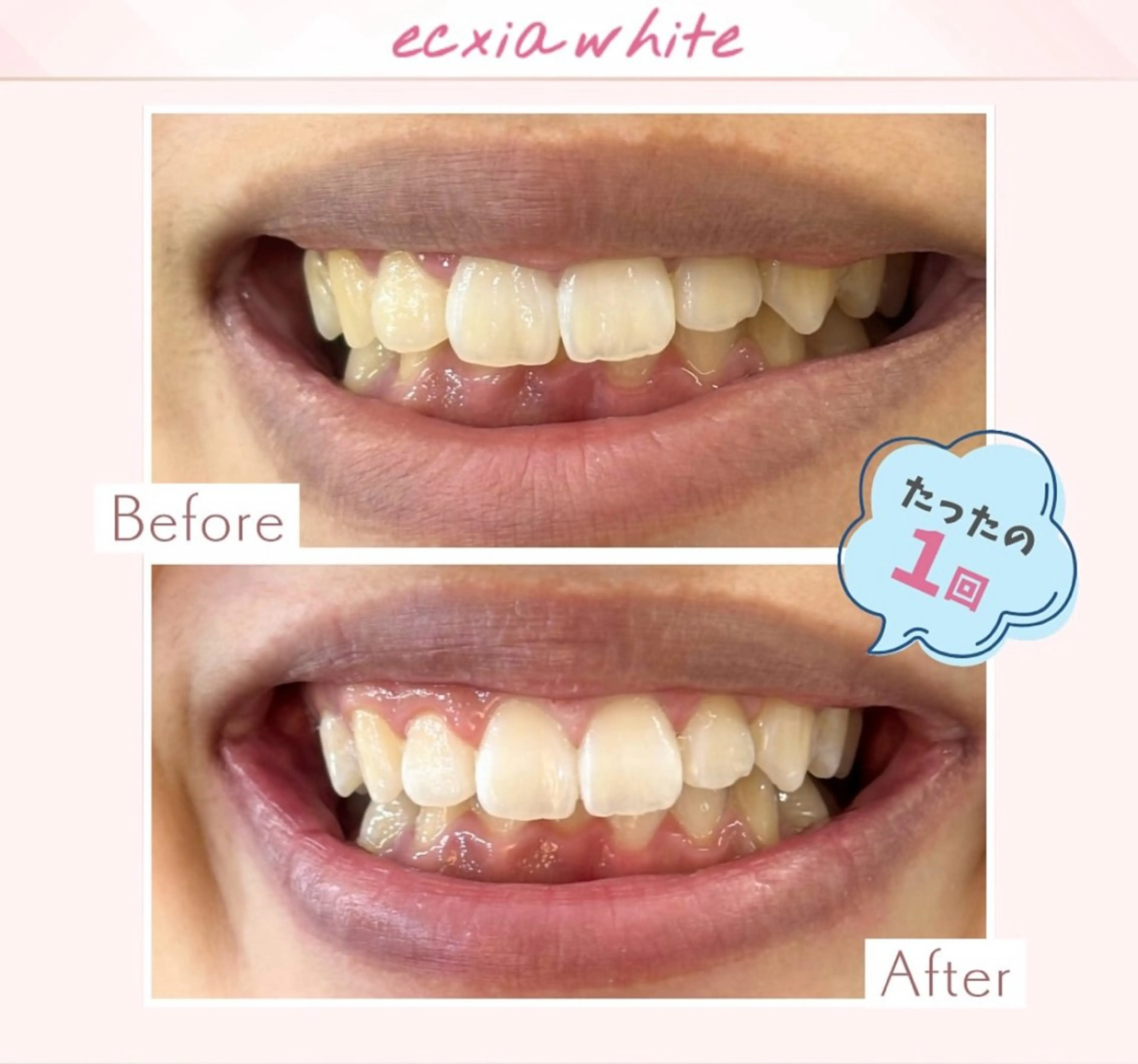 yumi❤︎ ホワイトニングのその他イメージ