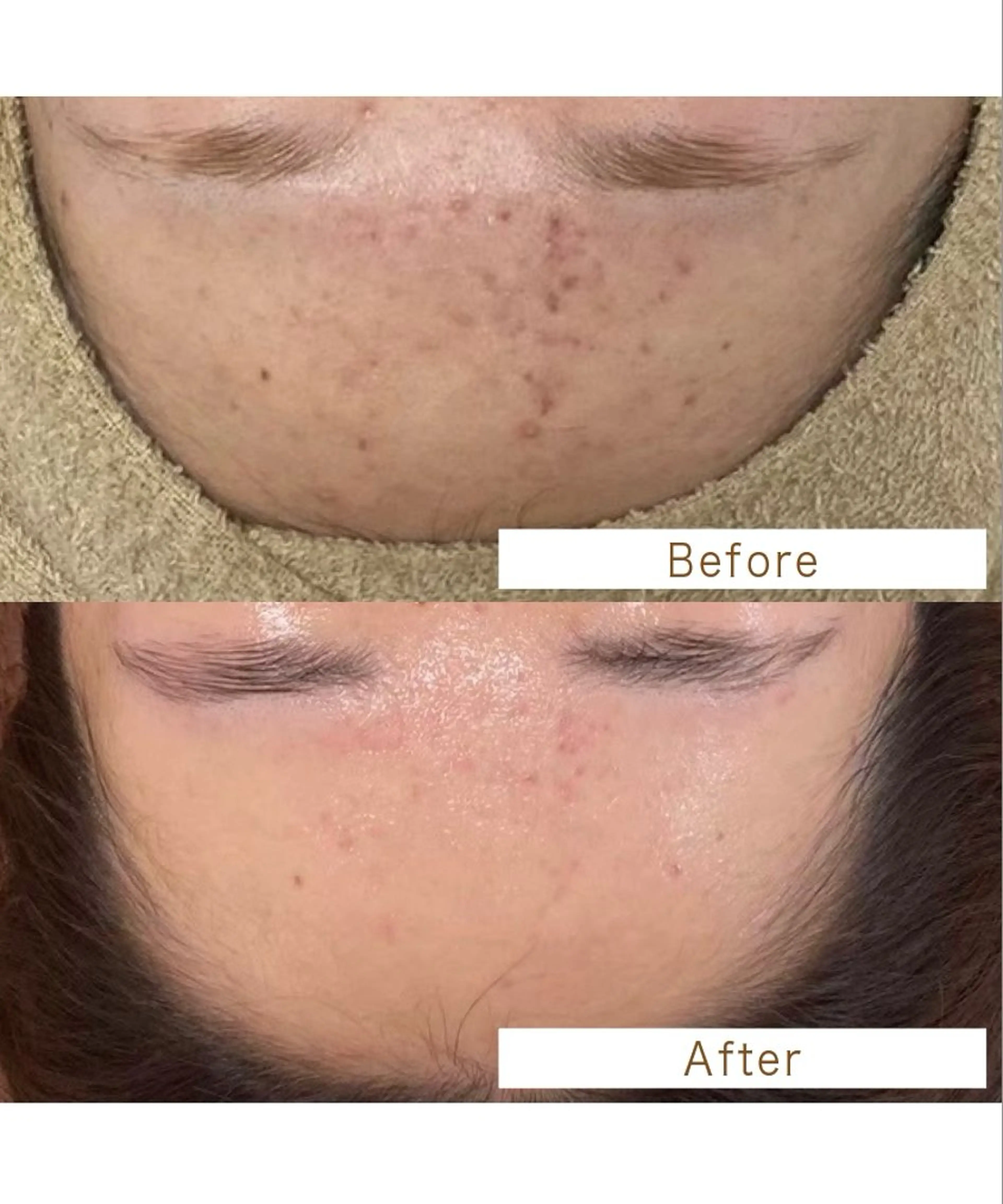 お顔のニキビケアにおすすめ！ハーブピーリング＋保湿パックの写真