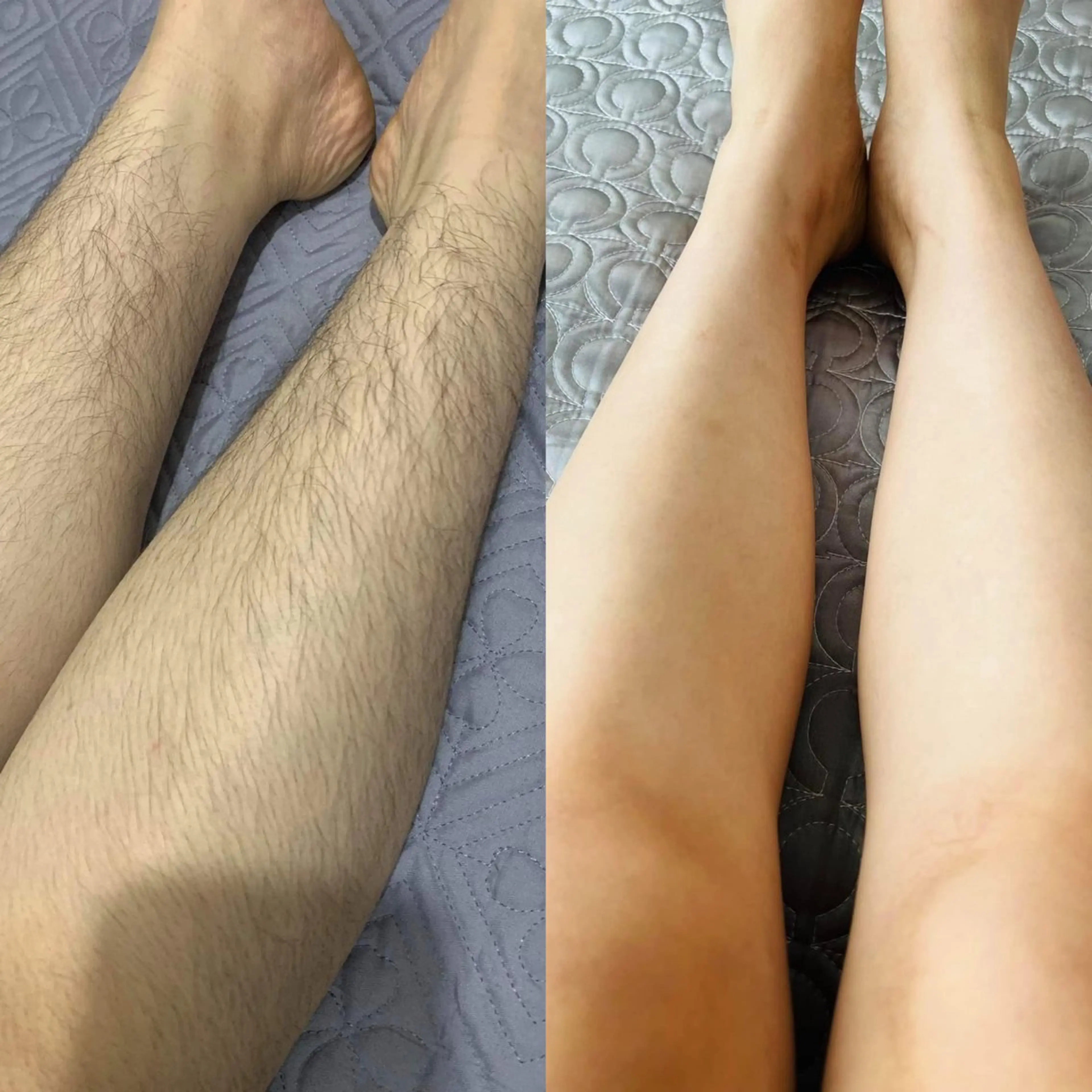 あし脱毛の写真