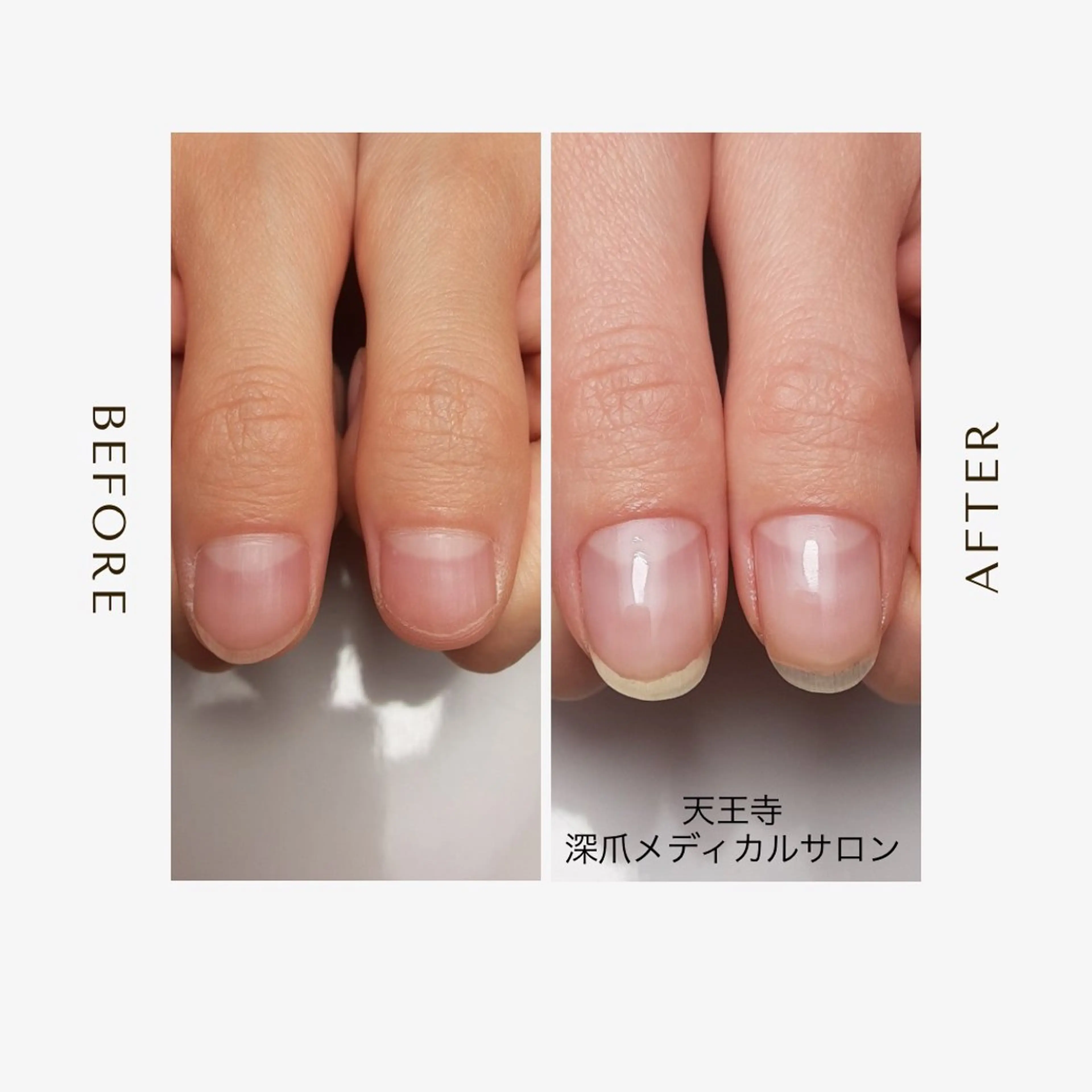 ネイル ハンドネイル ハンドケア 天王寺 深爪メディカルサロンのネイルデザイン