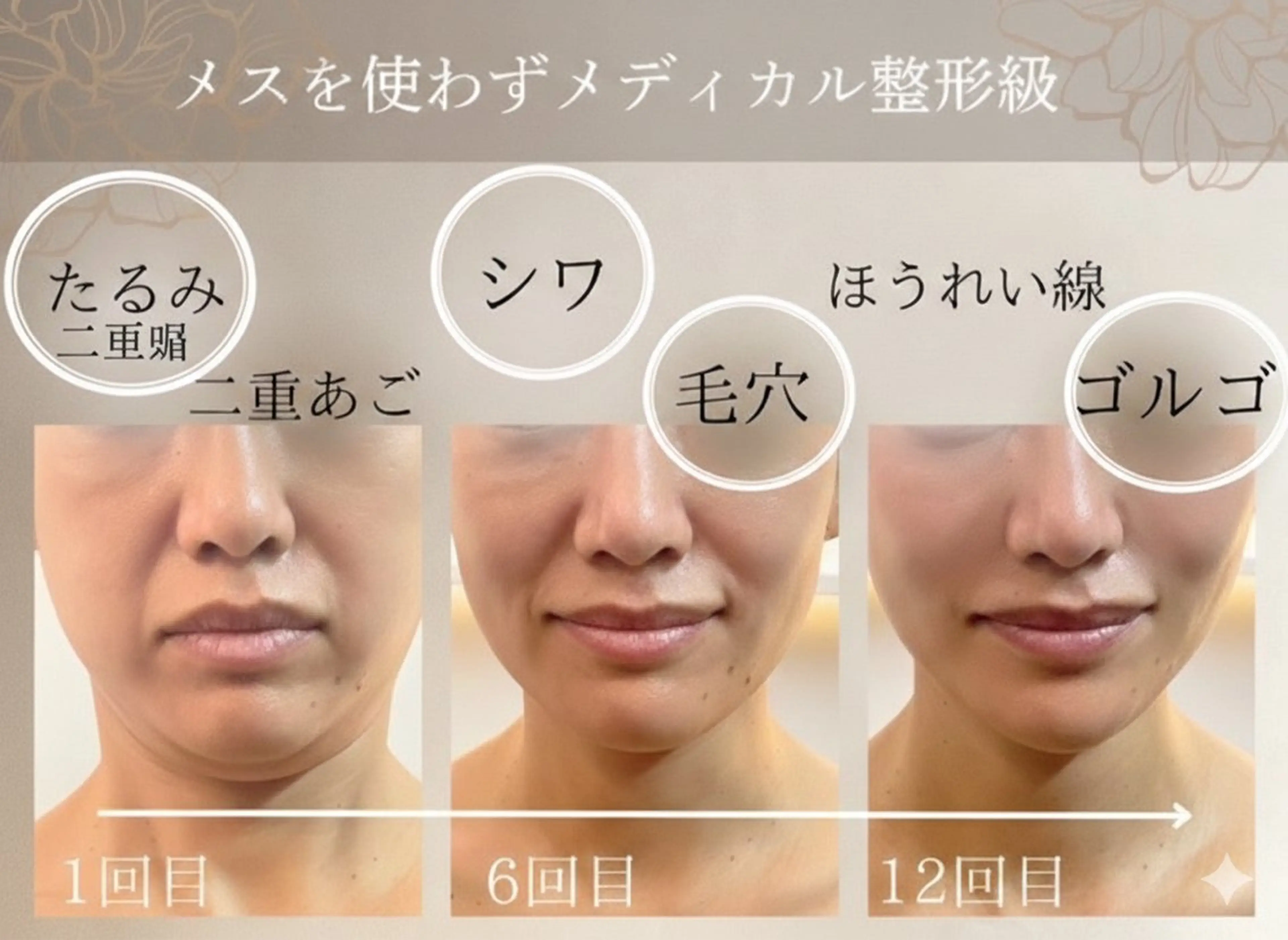 【初めての方お試し】最新Vリフト小顔アップマシン体験!※機械のみ￥12900→4999円の写真