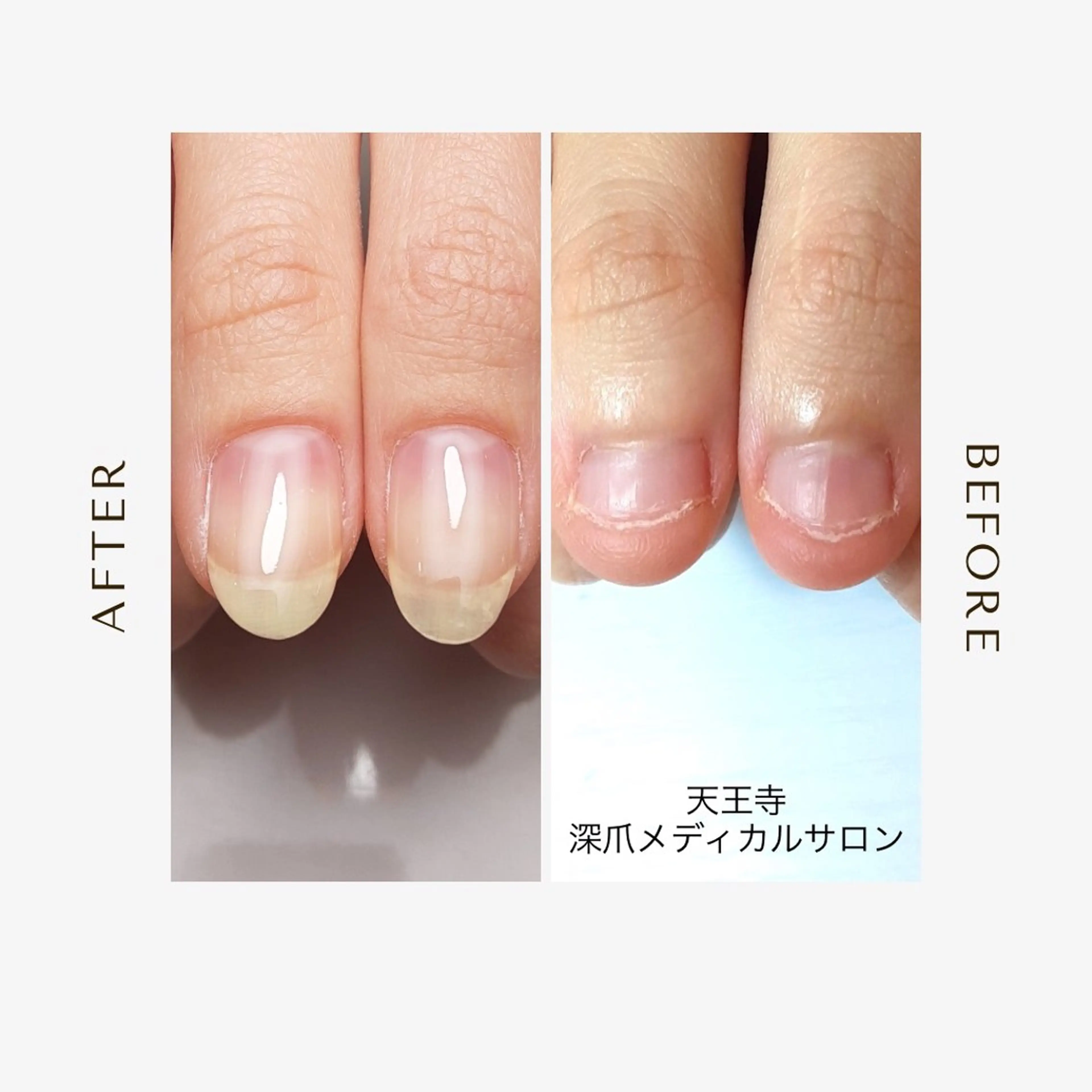 ネイル 天王寺 深爪メディカルサロンのネイルデザイン
