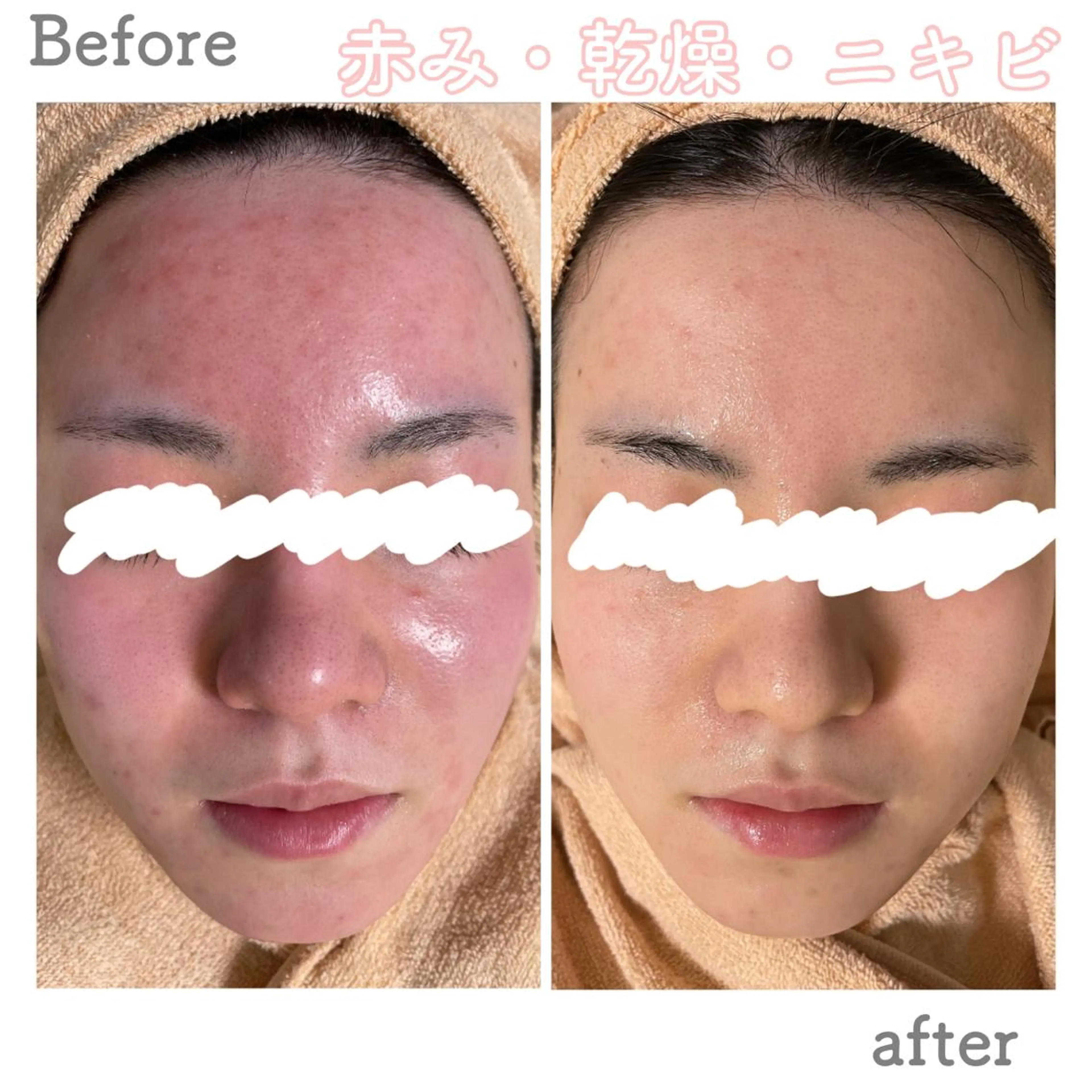 【体験後メイクされない方】人気NO.2🔥肌荒れ改善⚡️細胞活性機械🧖‍♀️ニキビレス、毛穴肌卒業✨の写真