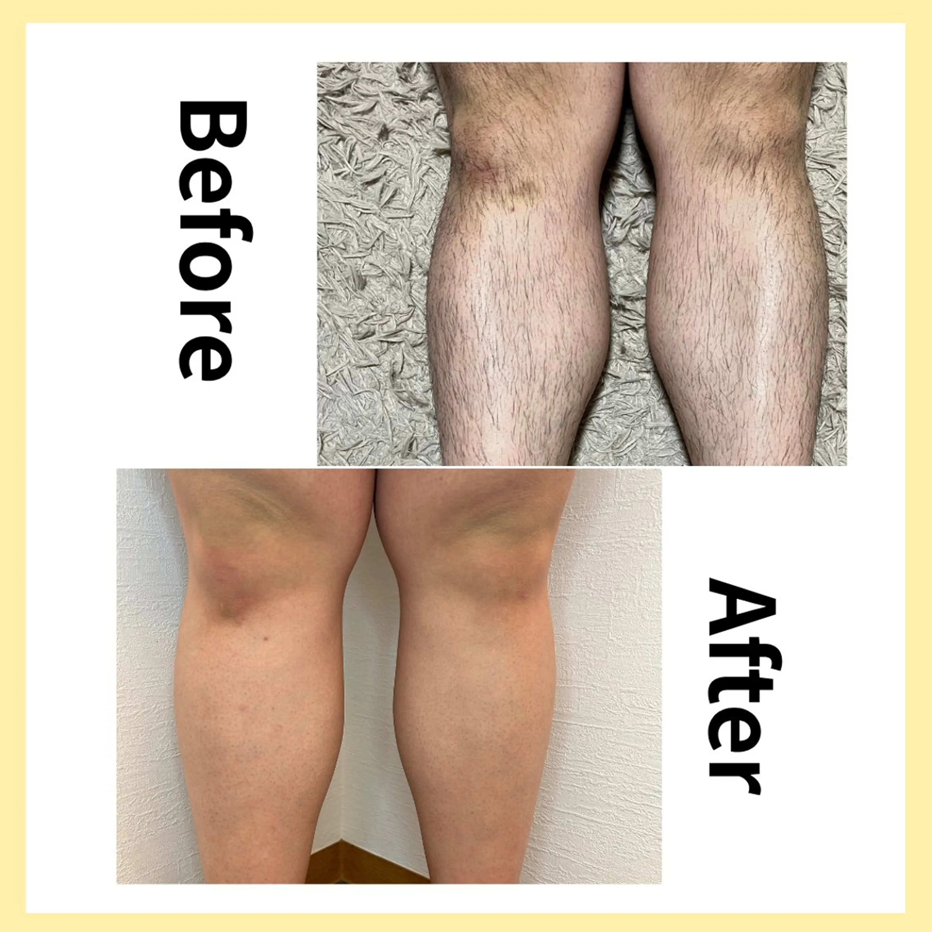 脱毛 セルフ脱毛/美尻イス キングスサロン熊本のエステ・リラクイメージ