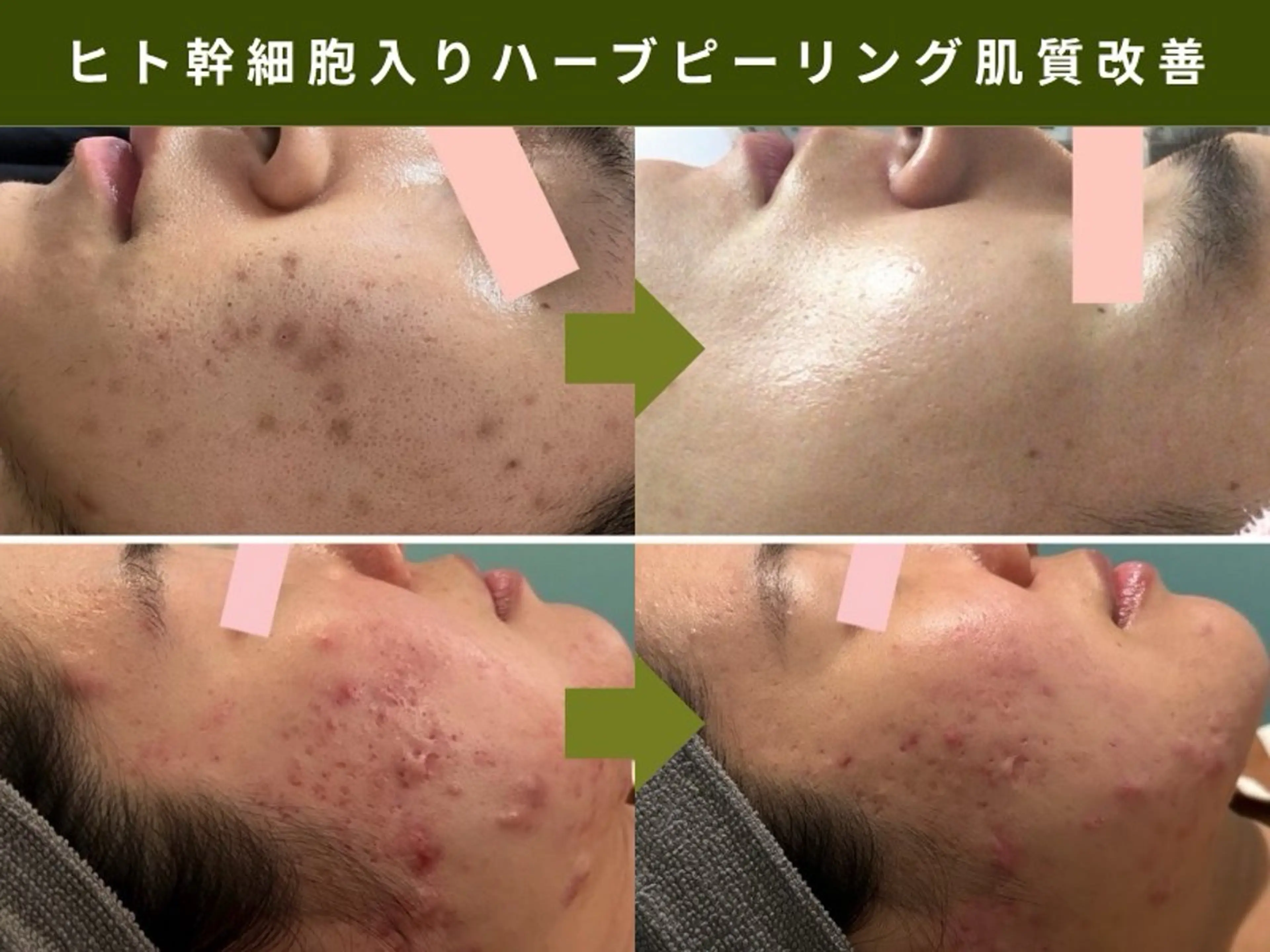 ハーブピーリング肌 管理🌿Ante関内のエステ・リラクイメージ