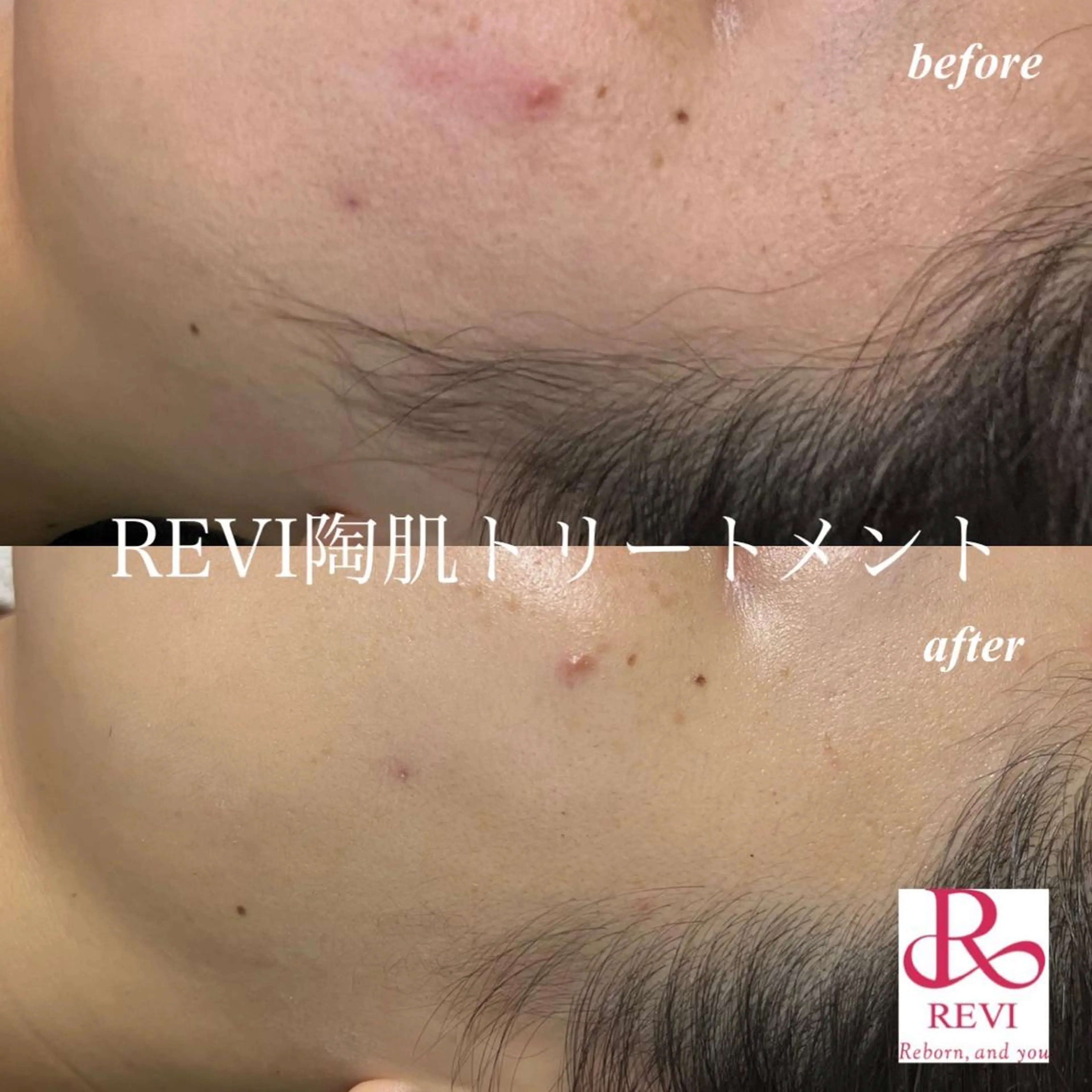 【3月末まで期間限定】お試しハーブピーリングの写真