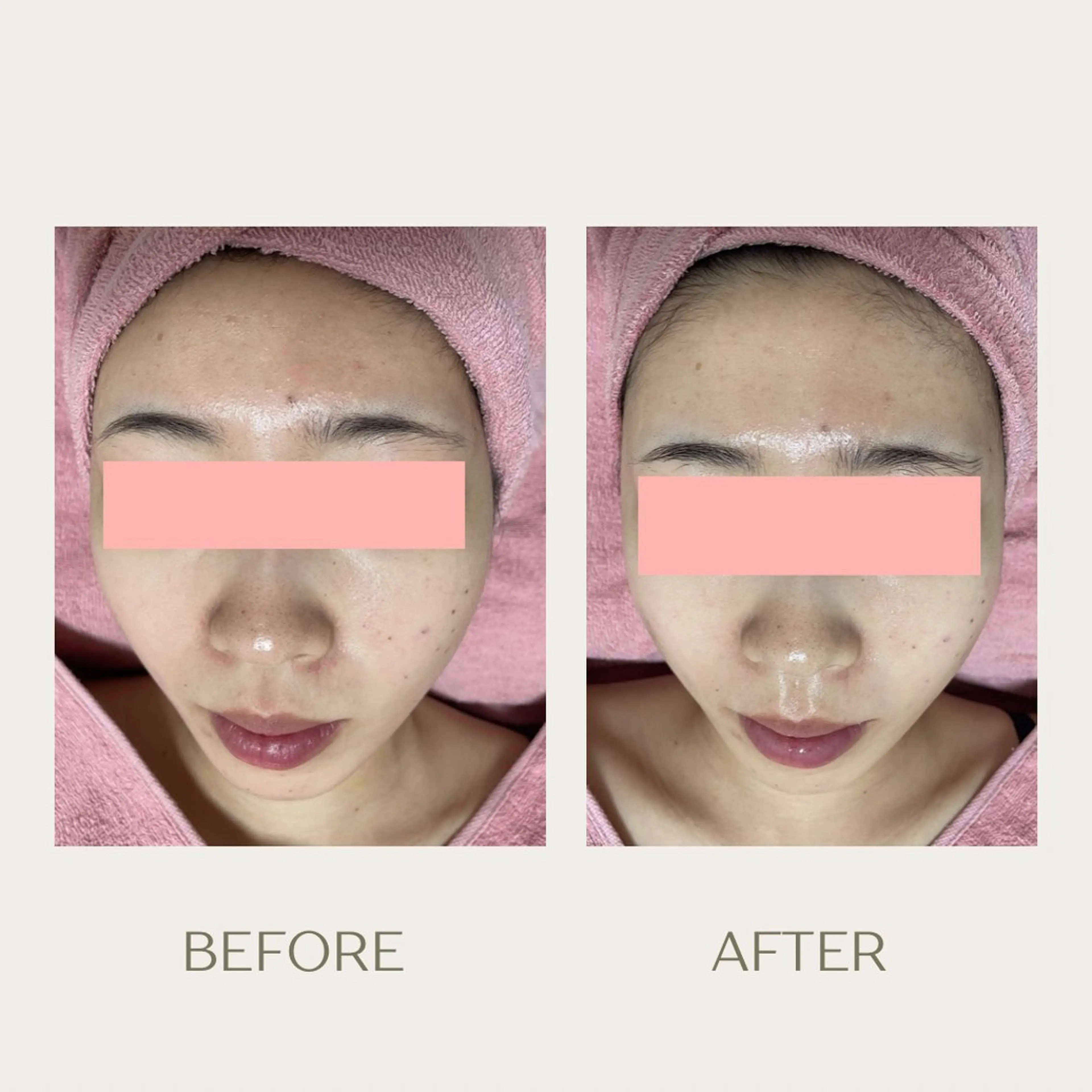 エステ ピーリングケア 🤍moekoのその他イメージ