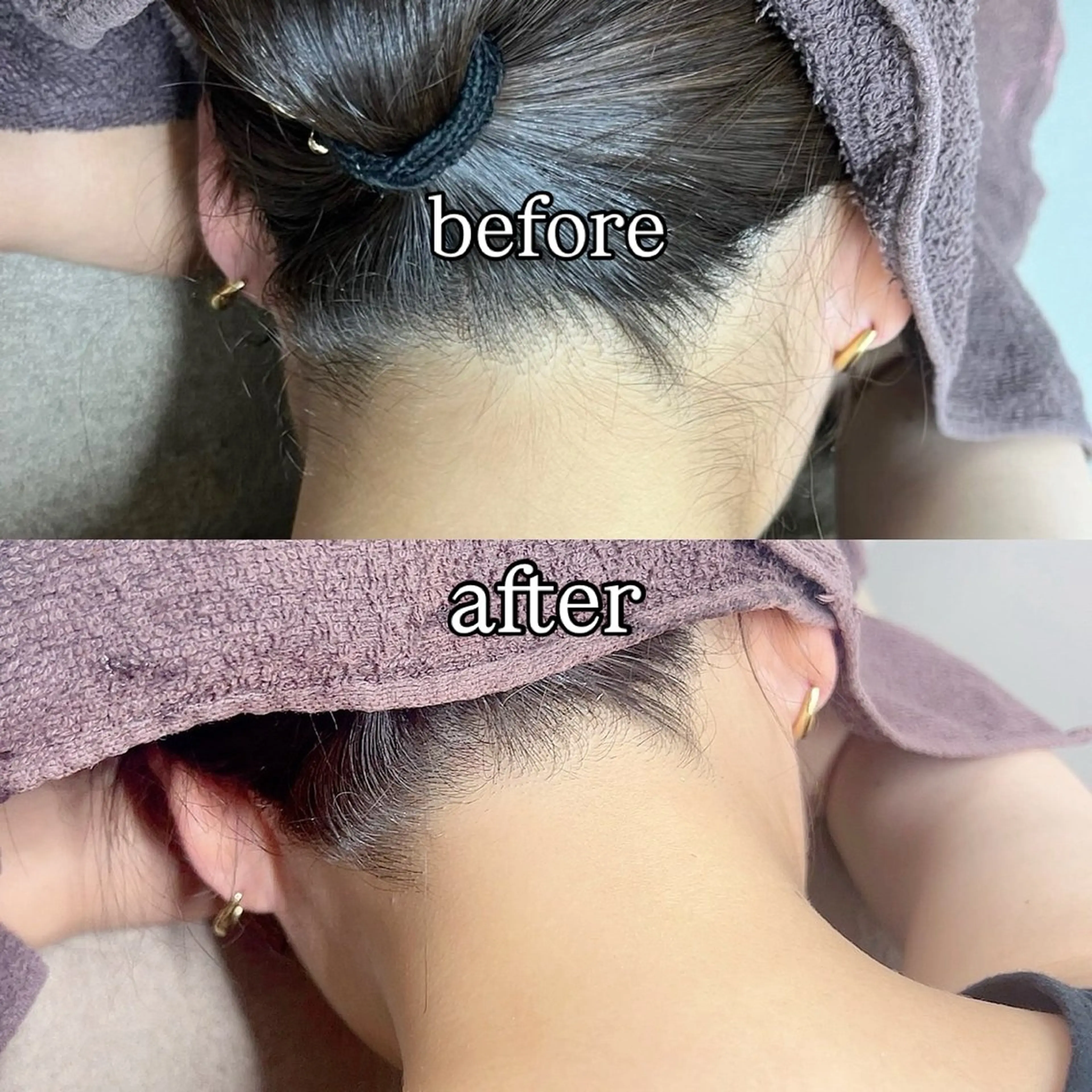 脱毛 smileskin 京都／meguのその他イメージ