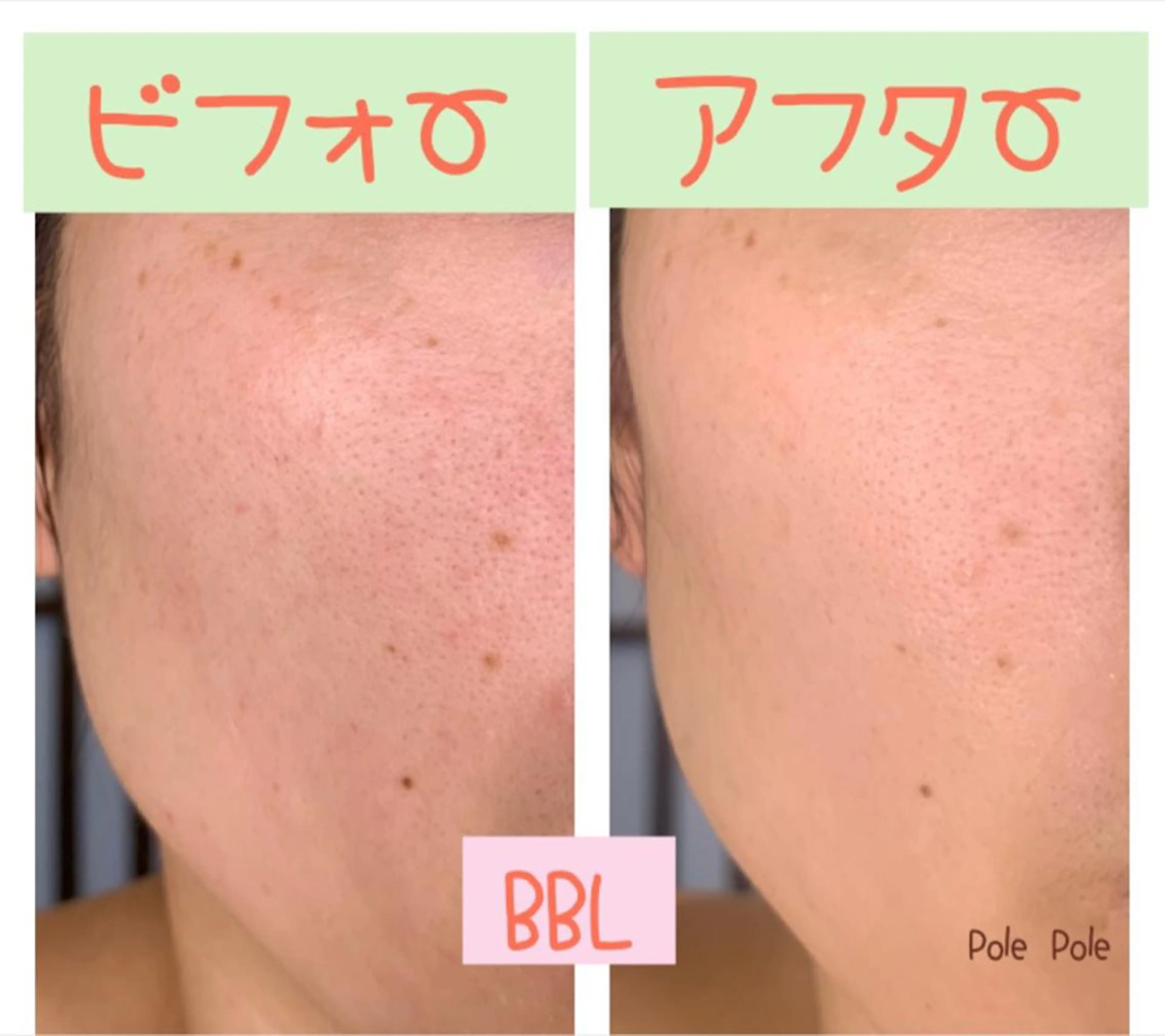 BBLフェイシャルの写真