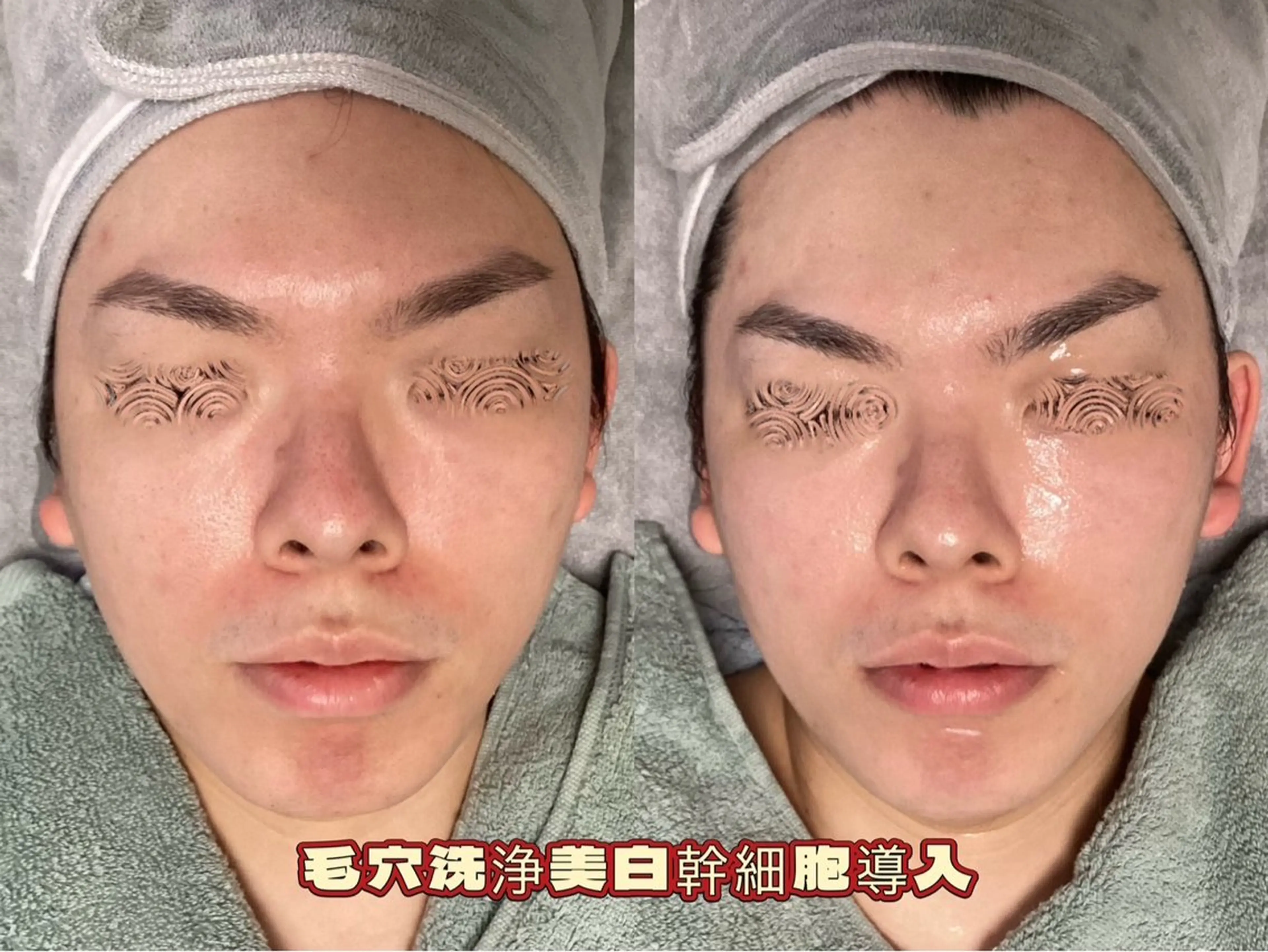 【メンズもOK、プレミア毛穴レス/陶肌ケア】★毛穴洗浄×光フェイシャルの写真