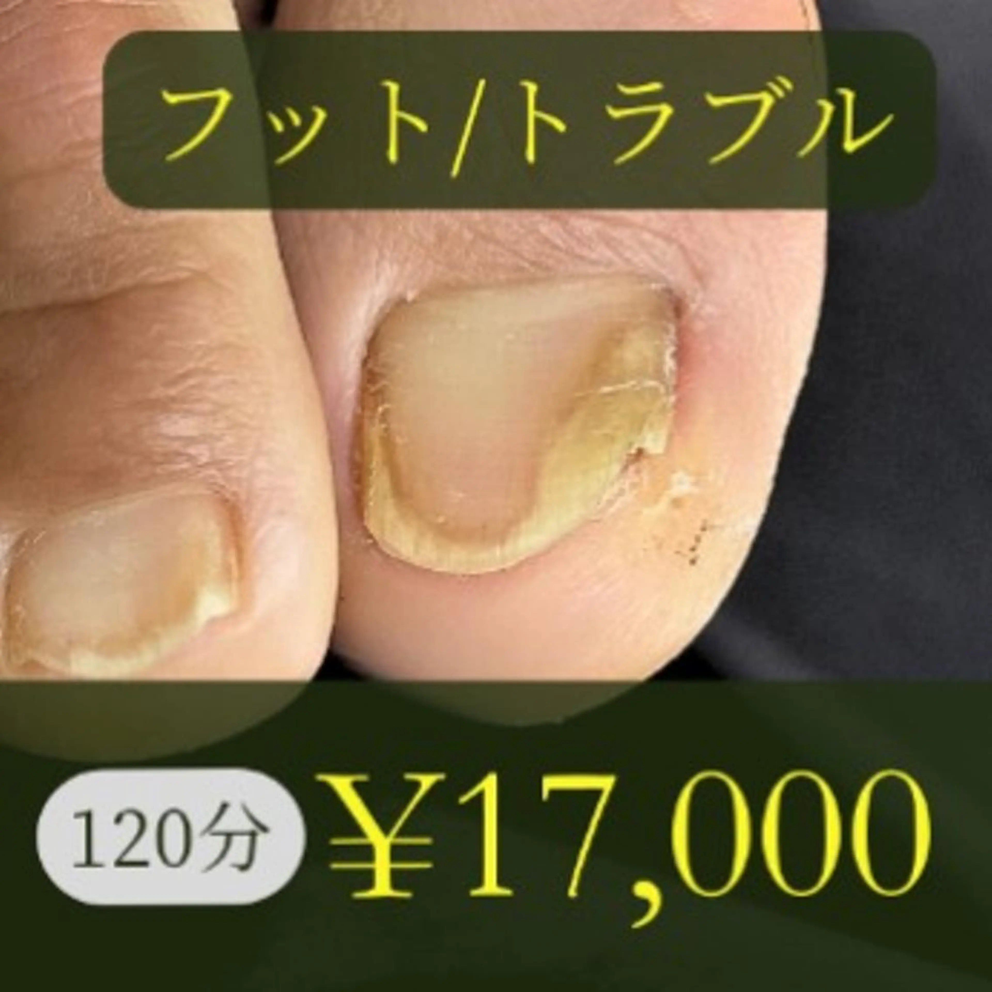 【初回】トラブル爪+育成ケア(120分)の写真