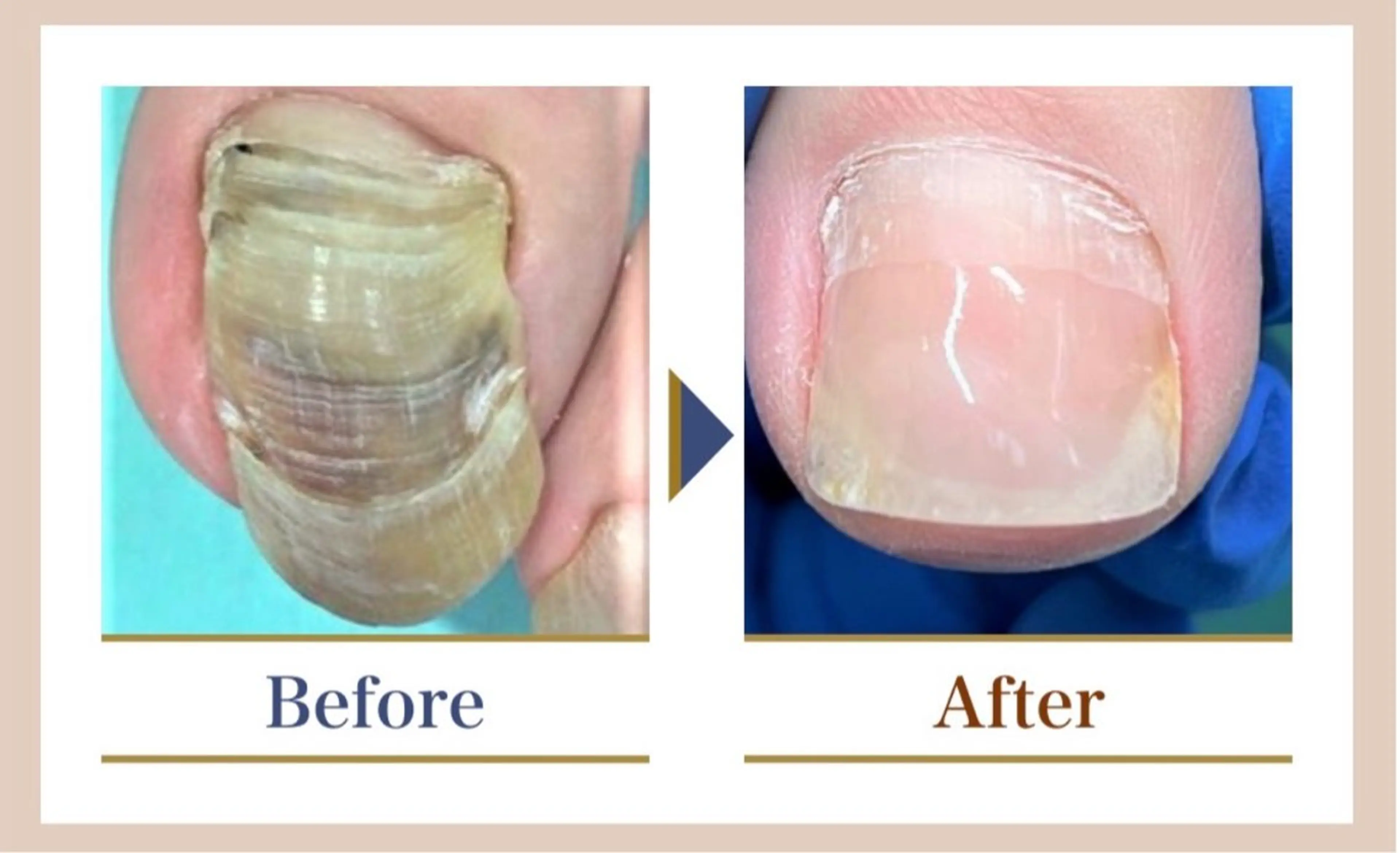 [新規限定]【変形爪補正1爪(親指)】 + 【足の爪切りセット】 ¥8,250→¥6,600の写真