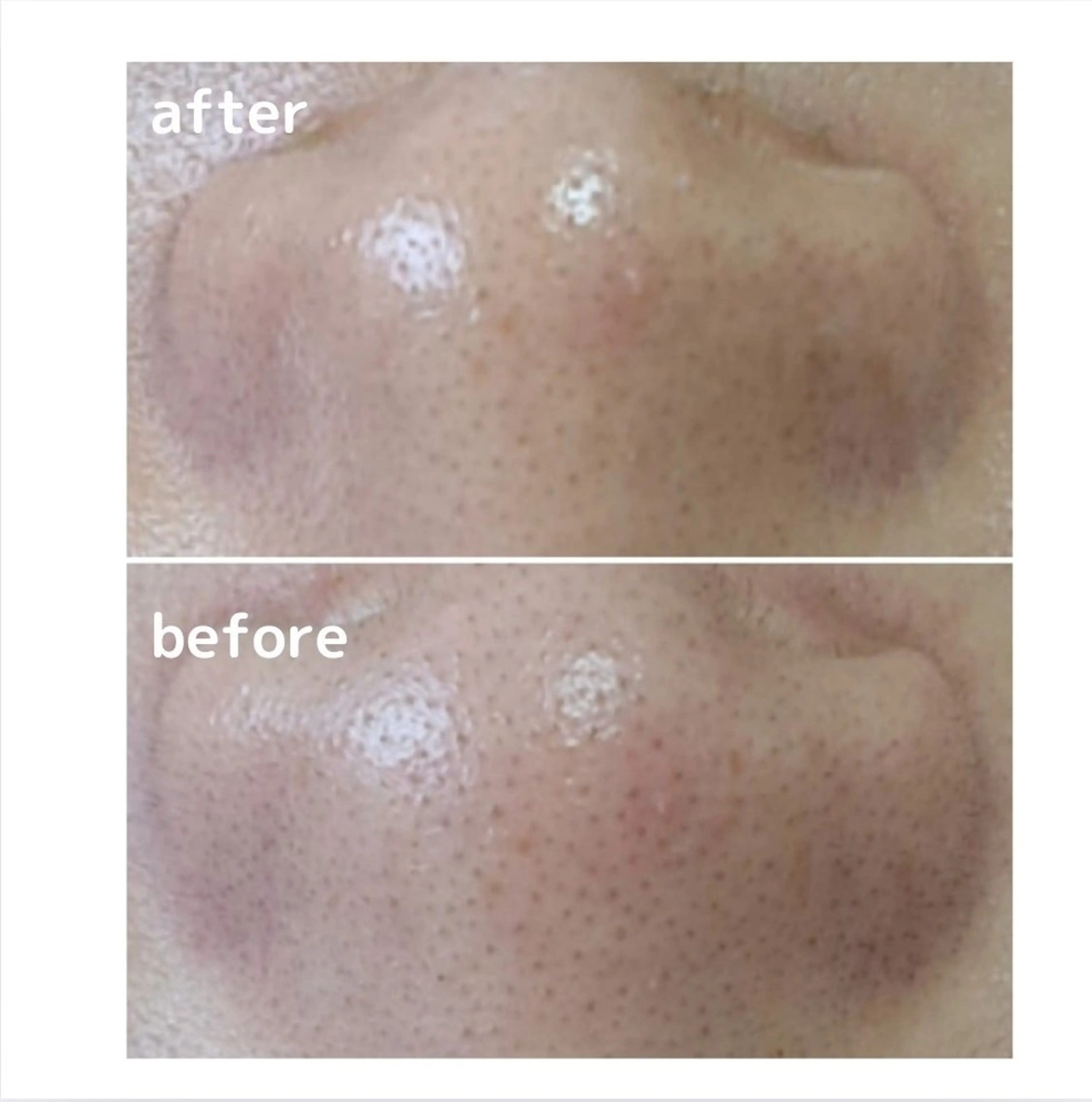 【小鼻の黒ずみが気になる方に】お顔全体の皮脂の酸化・毛穴づまりに　美シャインパウダー&デコルテマッサージプレゼントの写真