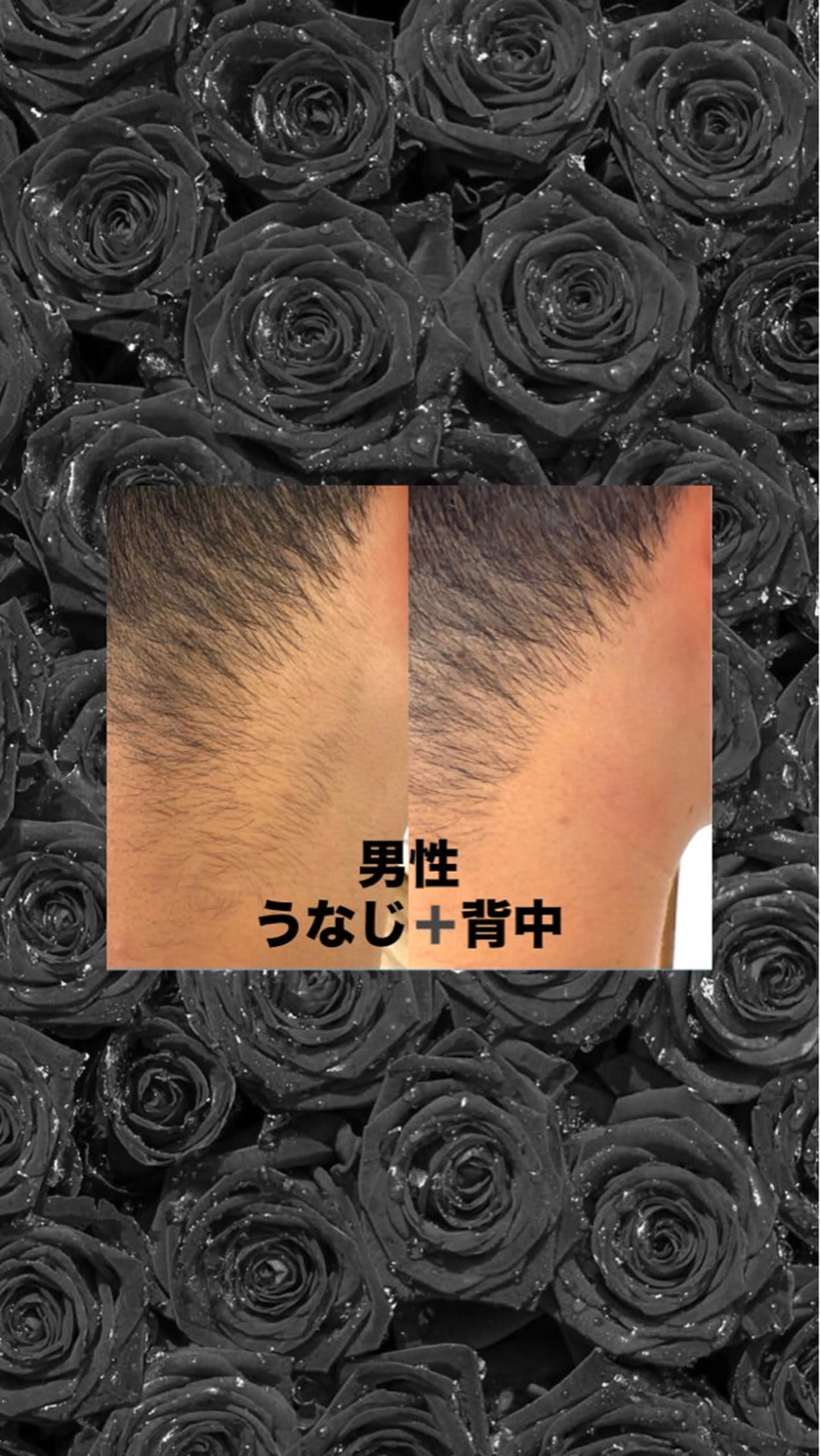 うなじ背中脱毛　男性脱毛の写真