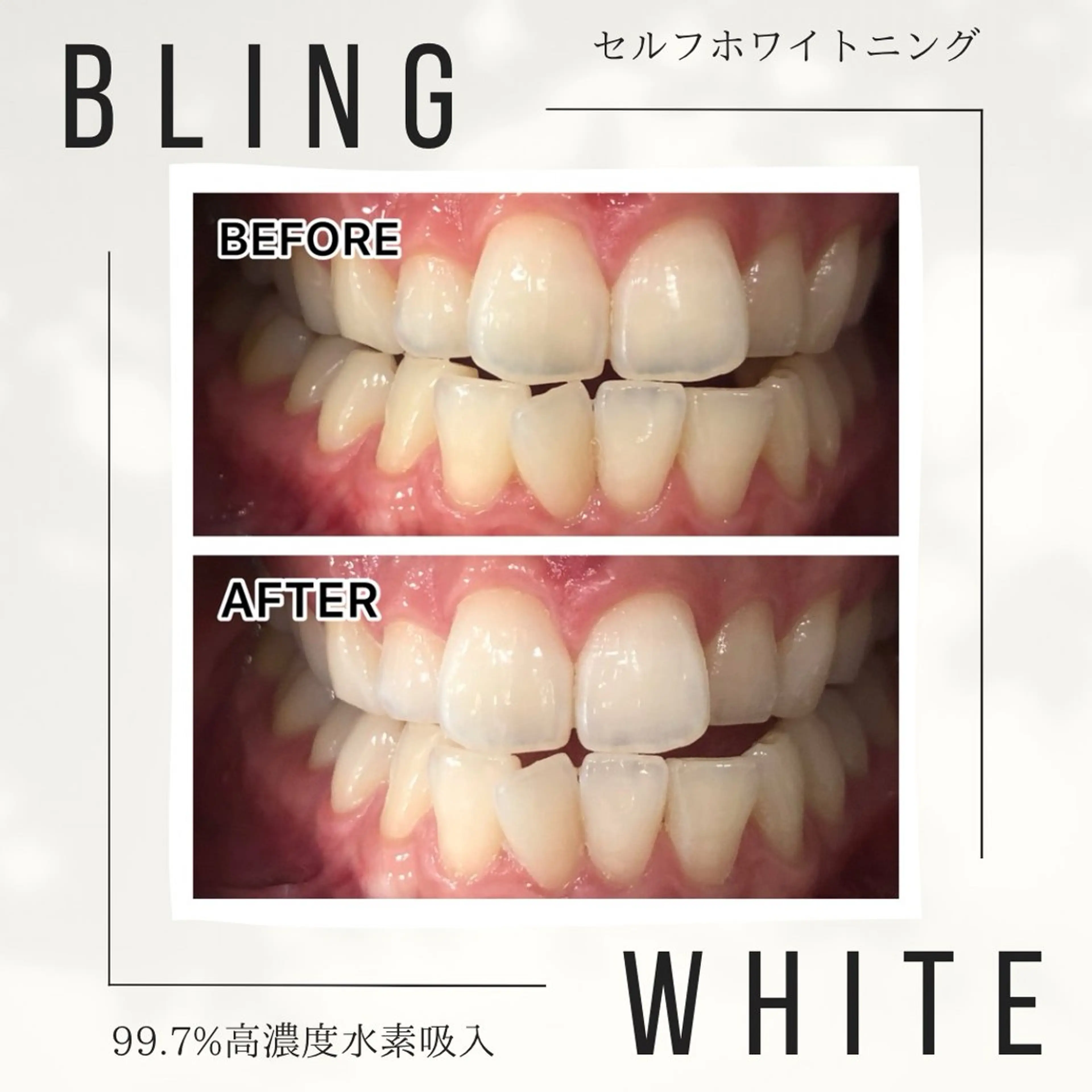 NEW OPENキャンペーン✨痛みシミなし・歯に優しい【短期集中美白一ヶ月3回コース】の写真
