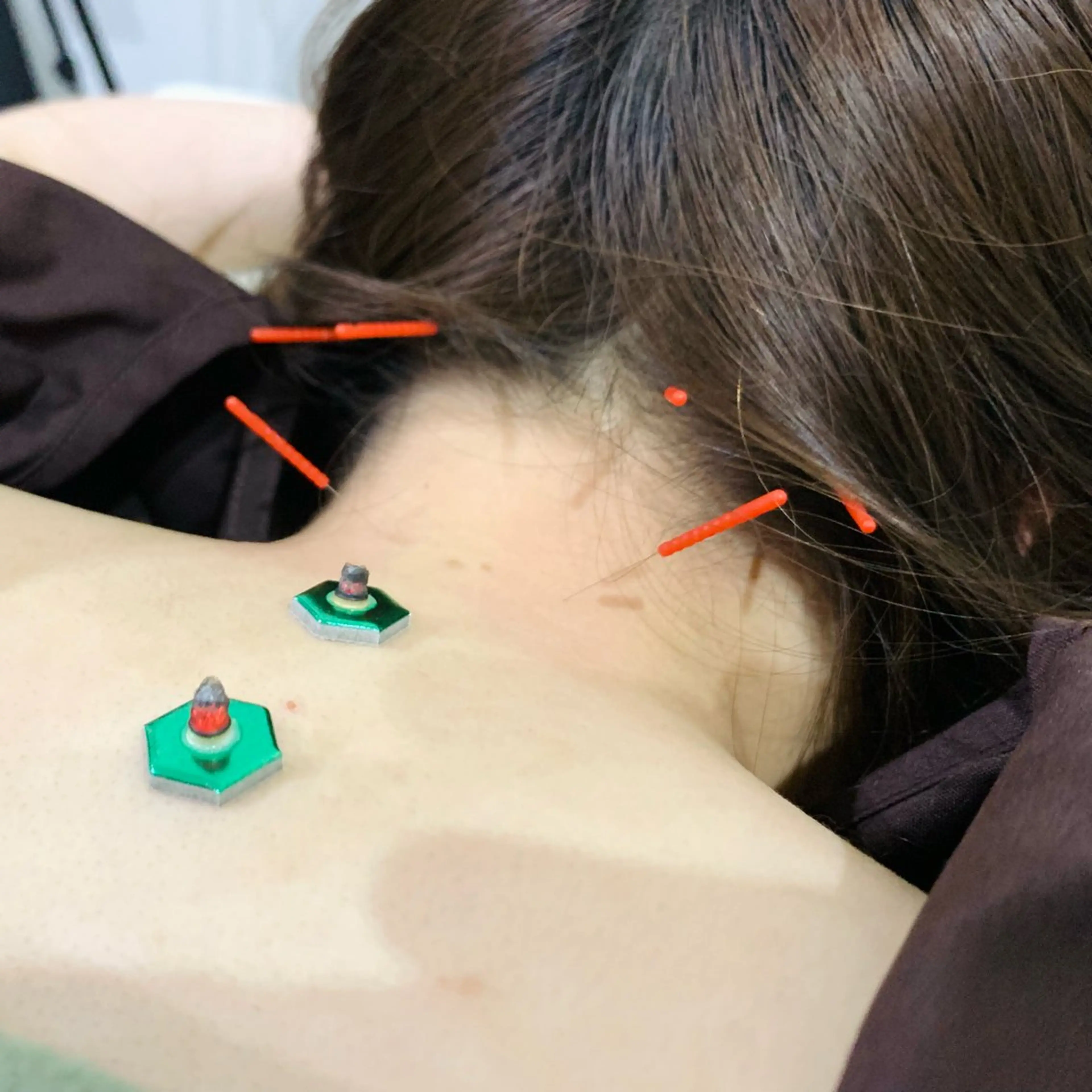 トリガーポイント・ボディケア鍼灸の写真