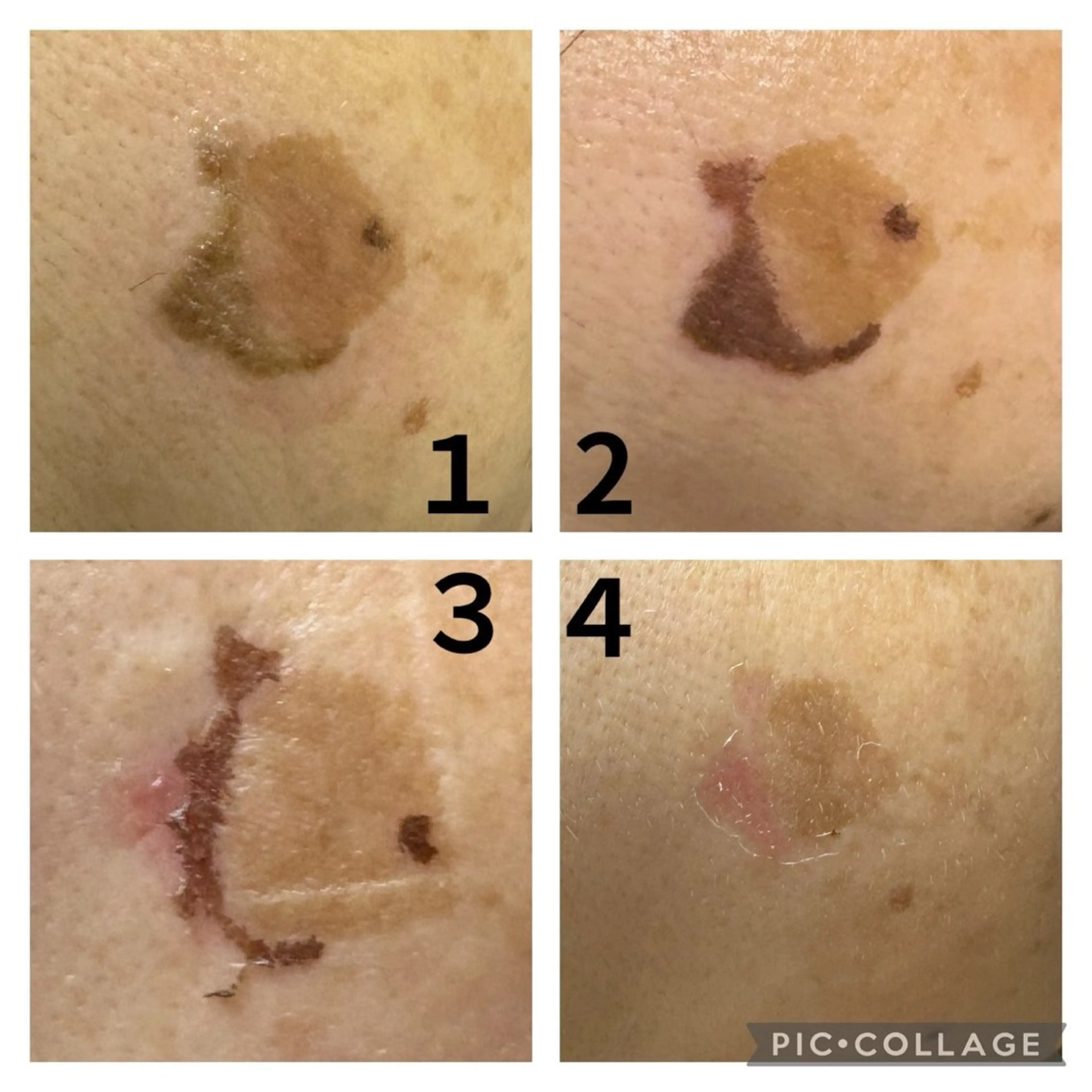 新規様限定❕是非お試し下さい✨️💗シミにお悩みの方おすすめです💗光フェイシャル➕シミスポットケア(15分)の写真