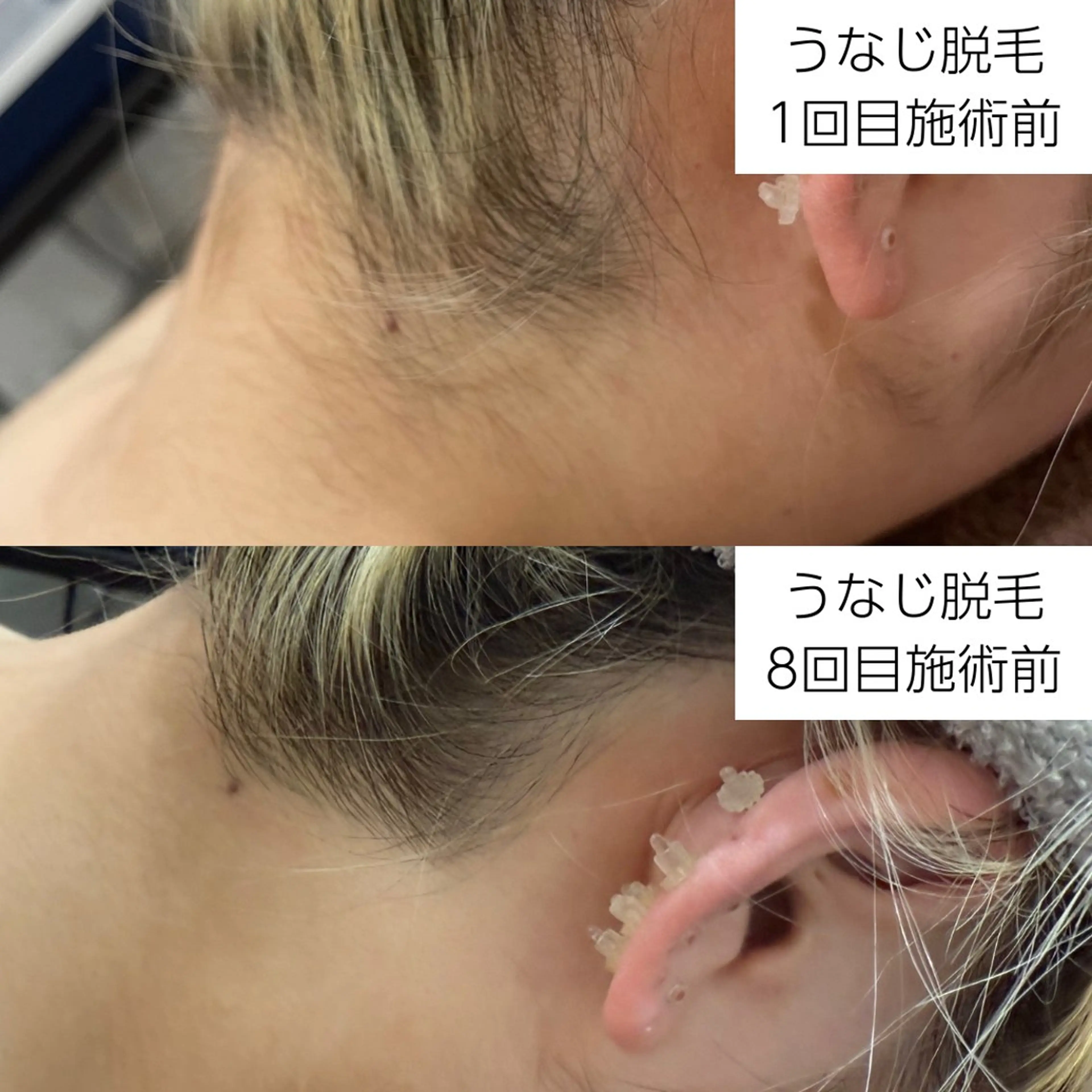 脱毛 vary  clue MISAのその他イメージ