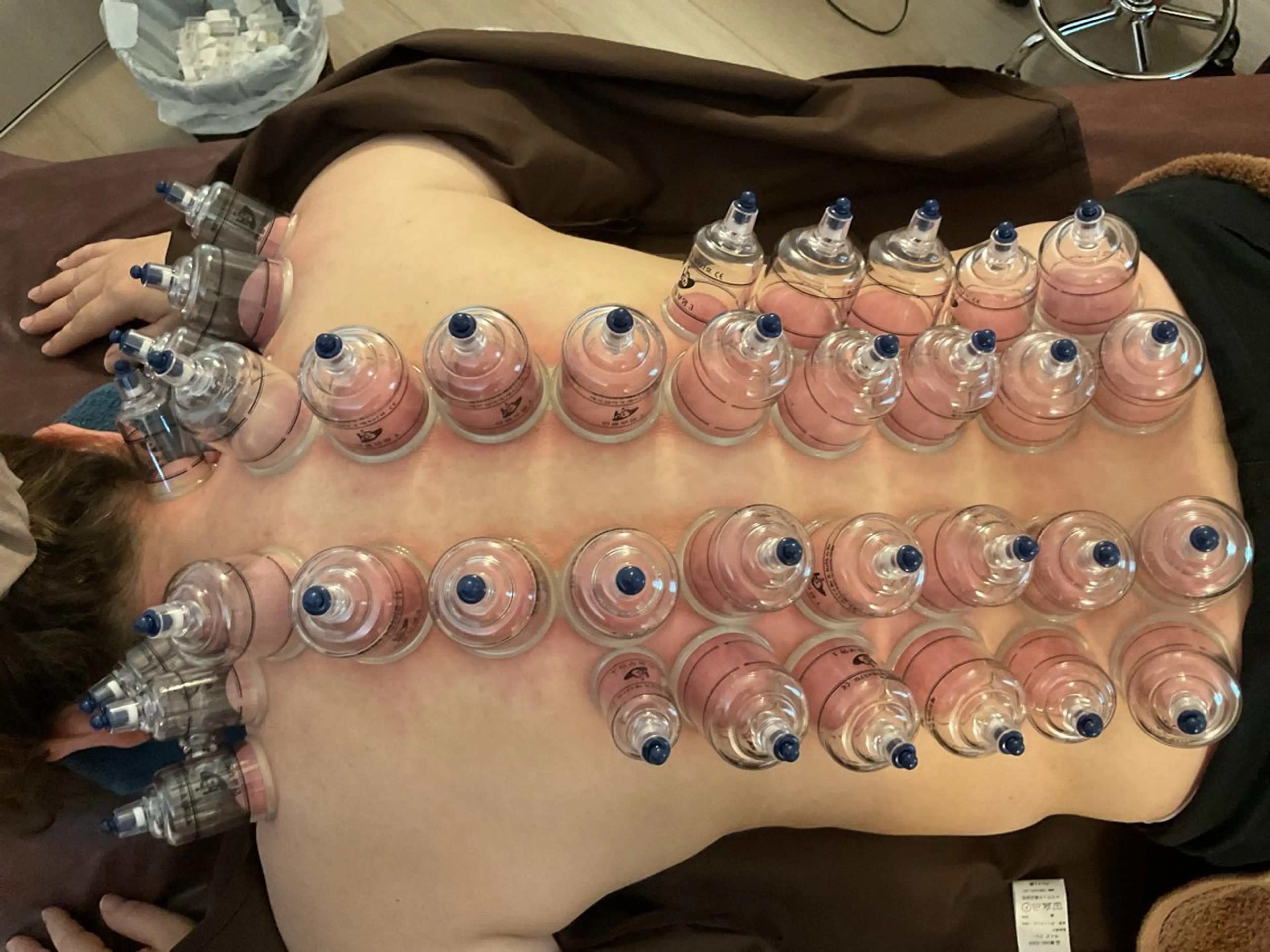 美楽鍼 びらくしんのその他イメージ