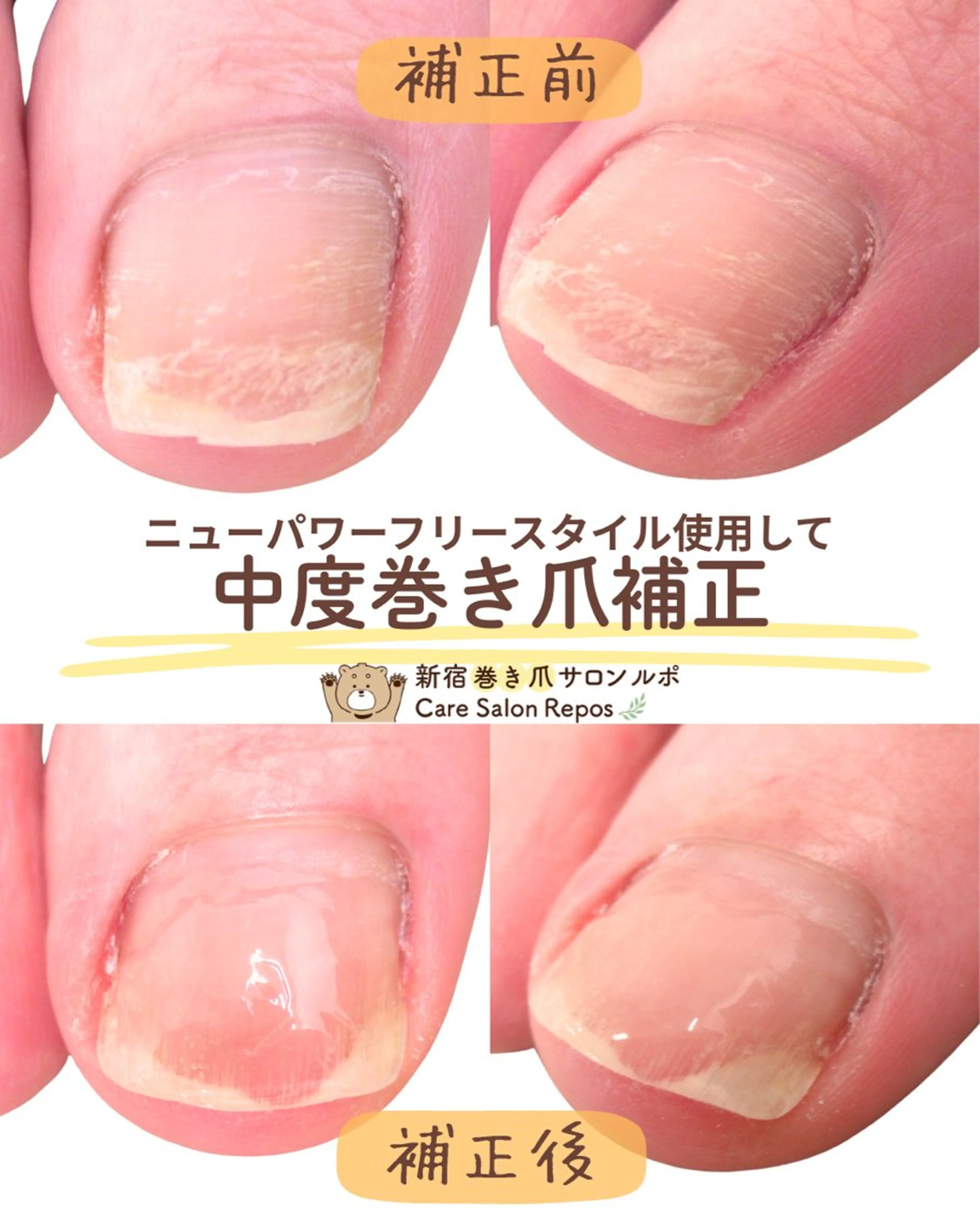 ネイル フットネイル 新宿巻き爪ケア ルポのネイルデザイン
